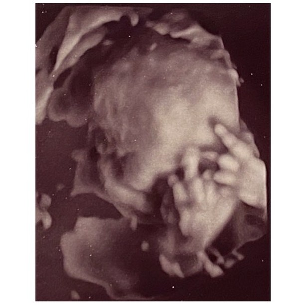 this is what a 3D scan looks when your baby is 25 weeks! A bit shy!
#3dscanning #3dscan #obstetrician #fetalmedicine #obstetrics #antenatal
@eileithyia_maternity
@chelwestft