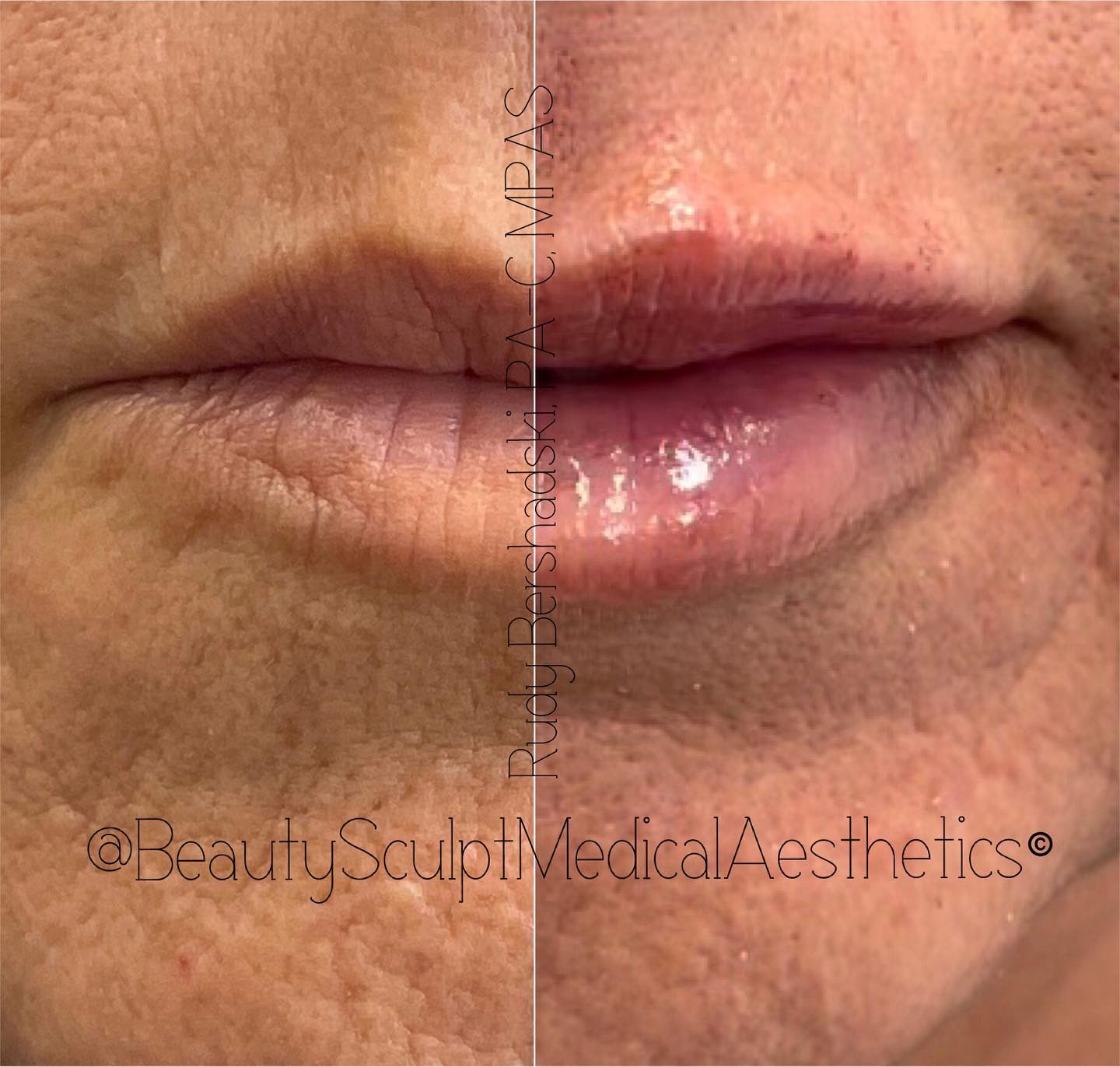 💋 L I P S 💋
Ready for the ultimate rejuvenation experience? 📞 239-777-5002 for a complimentary consultation.
.
.
.
_________________________
#fillers #lips #beforeandafter #knowyourinjector #hyaluronicacidfiller #medicalaestheticsnaples