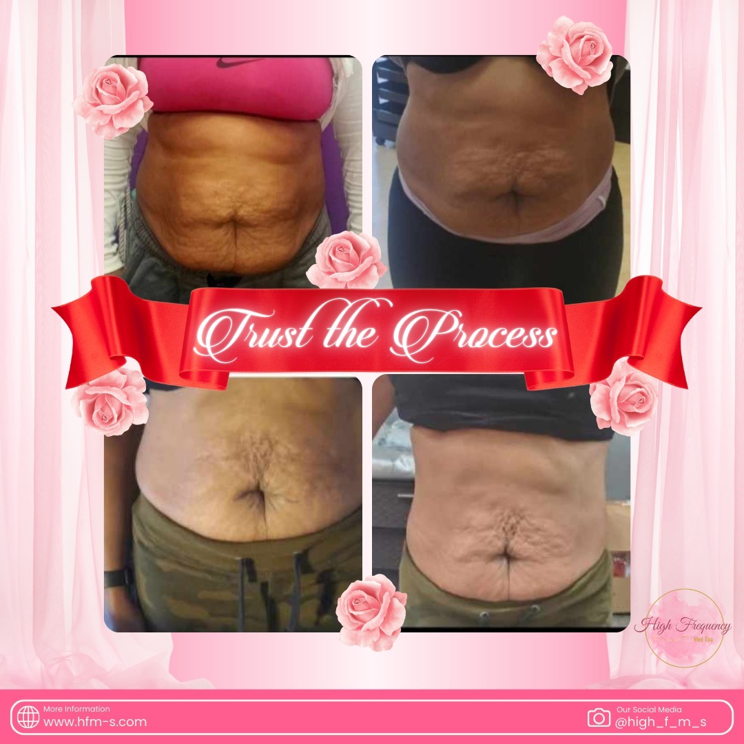 ✨ What happens when you trust the process? ✨ You transform! 💪🏾🌟
Check out incredible journey from “Who’s that?” to “Yaaas, girl!” 🔥 Progress isn’t just about the scale; it’s about every little victory along the way. From fitting into those jeans you thought you’d never wear again to feeling more confident in your own skin, every step counts! 🙌🏾
Remember, it’s not just about the destination but the strength you gain during the journey. Trust the process, celebrate the small wins, and keep pushing forward! 💖
📨Send me a message to know more!
#trusttheprocess #weightlossjourney #progressnotperfection #transformationtuesday #bodygoals #selflove #healthyliving #yougotthis #celebrateprogress #beforeandafter #journeytofit #fitfam #weightlossinspiration #keepgoing #motivationmonday #wellnesswarrior #fitspiration #healthyhabits