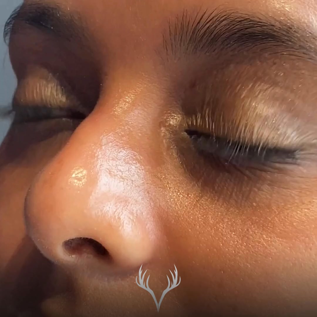 ✨ Hydrafacial – der Glow, der wirklich für alle funktioniert ✨
Egal ob trockene, ölige, unreine, sensible oder reife Haut –
egal welcher Hautfarbtyp: Hydrafacial ist für wirklich ALLE geeignet.
💧 Warum wir Hydrafacial so lieben:
– porentiefe Reinigung
– intensive Durchfeuchtung
– sanftes, kontrolliertes Peeling
– sofort sichtbar frischere, glattere Haut
✨ Das Beste daran:
✔️ keine Ausfallszeit
✔️ keine Rötungen, kein Schälen
✔️ sofort gesellschaftsfähig
✔️ dieser typische Hydrafacial-Glow, den man nicht schminken kann
🔬 Die Behandlung arbeitet hautschonend, individuell anpassbar und ist daher auch perfekt für
– empfindliche Haut
– dunklere Hauttypen
– regelmäßige Treatments oder Event-Facials
🌟 Ergebnis:
Reine Poren, pralle Haut, gesunder Glow – direkt nach der Behandlung sichtbar.
📞 Termine bitte telefonisch oder über unser Online-Buchungstool
📍 Beauty Bar Baden