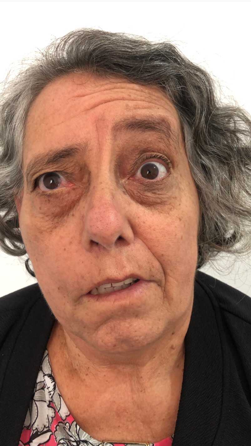 Este é o resultado com a técnica de terapia integrativas seguido de um protocolo conforme a queixa da paciente
Neste caso foi trabalhado a laserterapia, acupuntura e moxabustão!