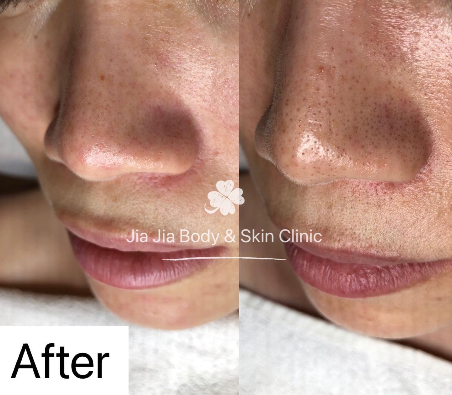 Blackhead remove with one treatment
#acnetreatment #acnepositivity #acnesolutions #acnescars #acnemarks #adultacne #clearskin #exfoliation #acnejourney #skincareobsessed #skinblemishes #acneproblems #acnetips #realresults #realresultsrealpeople #beforeafter #skin #pimples #acneproneskin #acnecommunity #sensitiveskin #acnefree#blackheadextraction