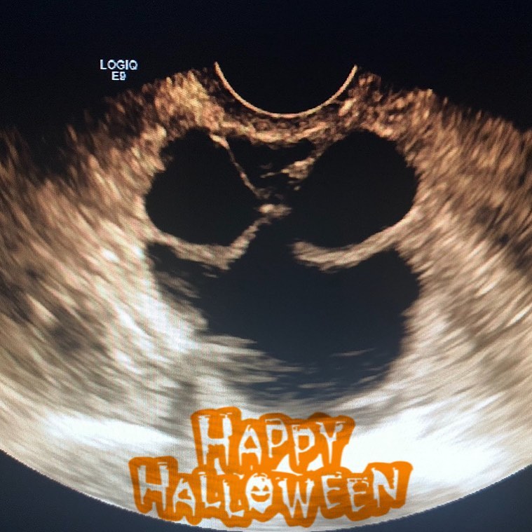 Happy Halloween 🎃
Just one angry ovary here 😆