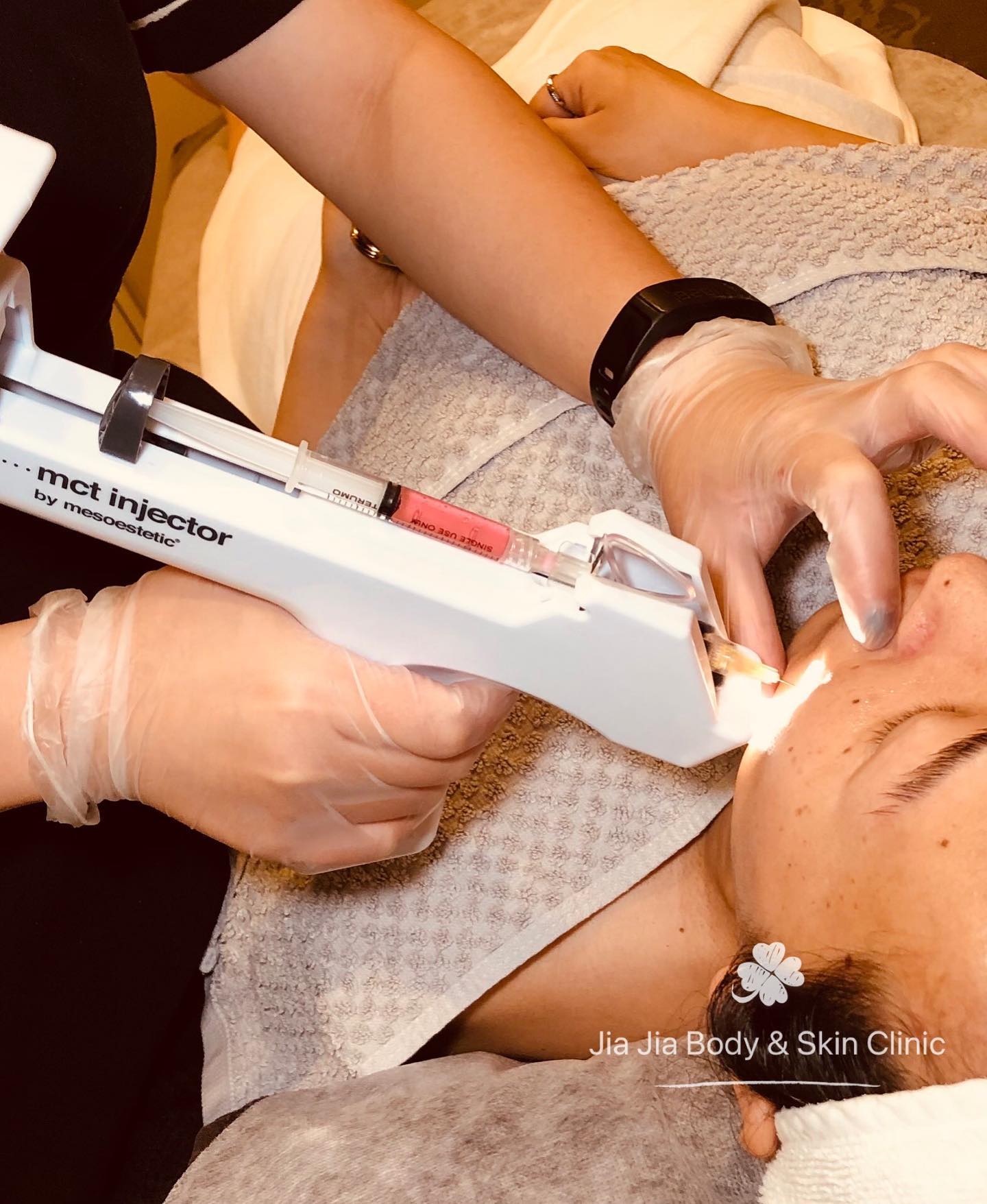 MESOTHERAPY
DIMINISH YOUR SKINāS PROBLEMATIC AREAS WITH MESOTHERAPY
Mesotherapy is a broad term used to describe the process of delivering active ingredients into the deeper layers on the skin to induce lipolysis or fat mobilisation.
#mesotherapy #skinbooster #mesoestetic #mctgun #jiajiabodyandskinclinic