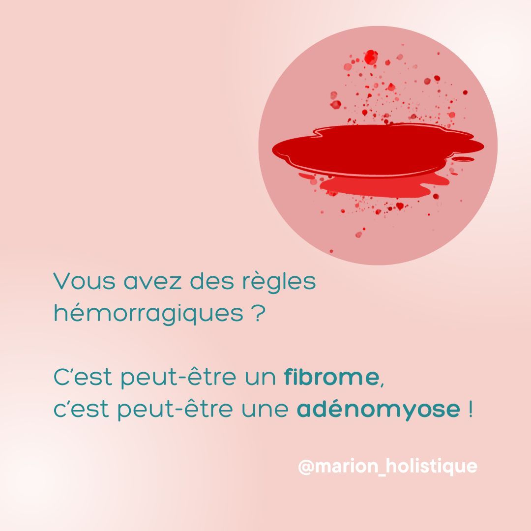Si vous perdez beaucoup de sang à chaque cycle, et même en dehors des règles, je vous conseille de consulter votre médecin pour faire les examen nécessaires pour exclure ou confirmer une pathologie gynécologique. Plus elles sont découvertes précocément, mieux elles sont traitées. Ensuite un prise en charge en médecine chinoise sera d'une précieuse aide pour améliorer votre qualité de vie autour de votre cycle féminin. #règles #reglesdouloureuses #regleshemorragiques #dysménorrhée #metrorragie #menorragie #adenomyose #fibromeutérin #endometriose #gynecologie