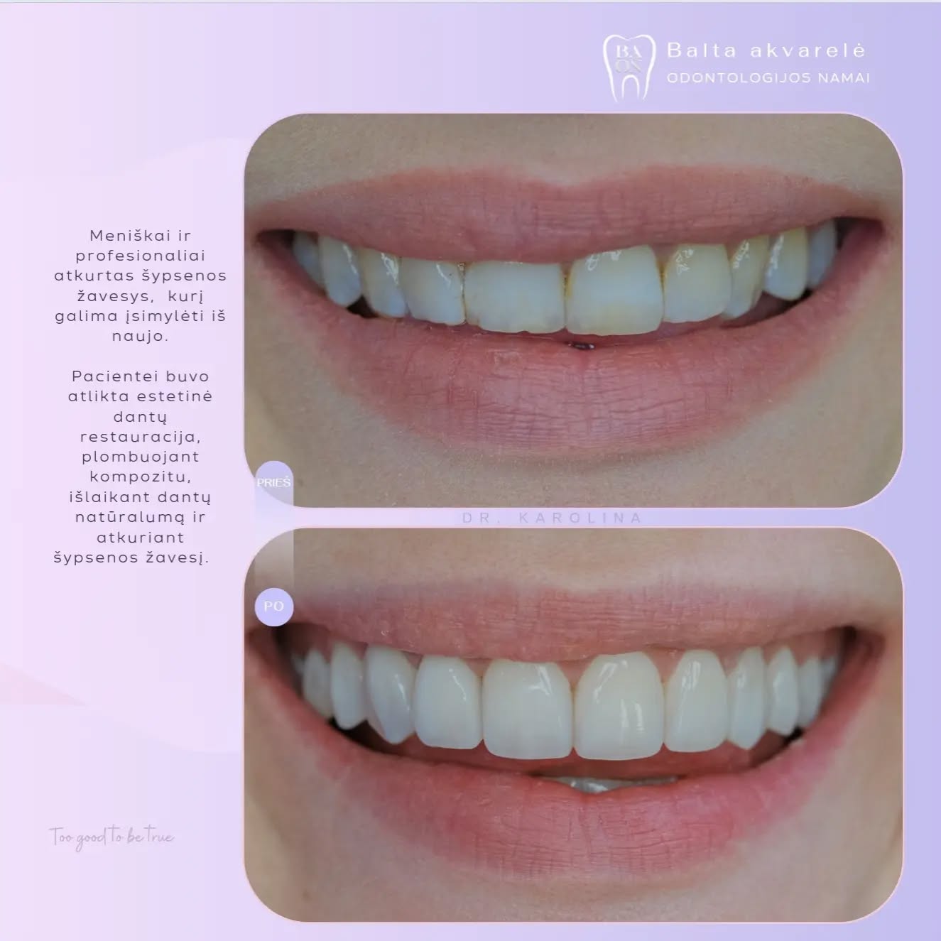Džiaugiamės puikiu rezultatu. Juk nuostabi šypsena atveria duris į dar didesnį pasitikėjimą...
Nuostabus gyd. Karolinos @karolina4smile darbas
.
.
.
.
.
#nuostabišypsena #sypsena #odontologijaklaipedoje #estetineodontologija #karolina4smile #dental #compositbonding #klaipeda #estetinisplombavimasklaipedoje #estetinis #odontologijaklaipeda #estetinisplombavimas #estetinisplombavimaskaune #estetinisplombavimasvilniuje