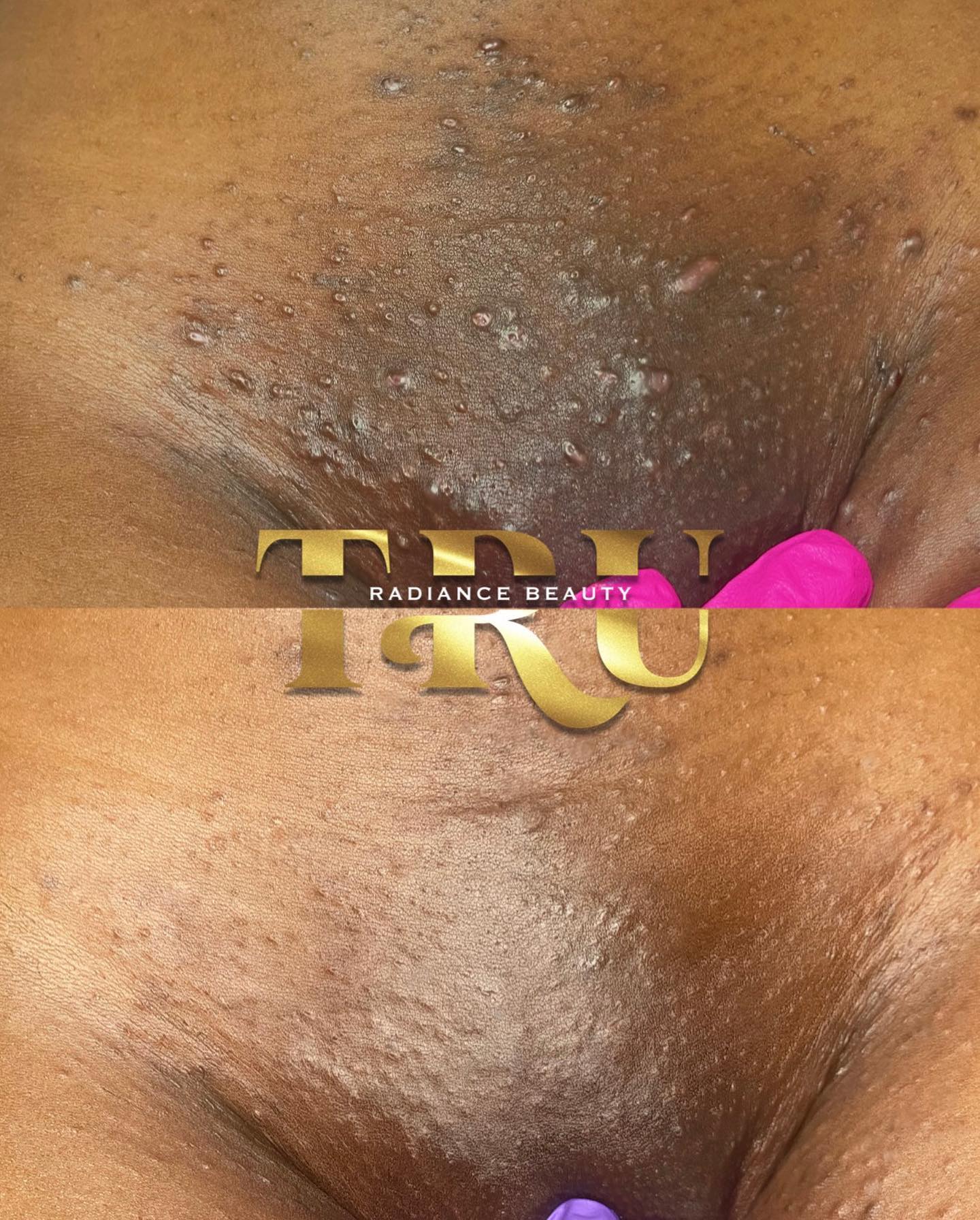 Update on my client who messed herself up by shaving ONE TIME after all the process we made with waxing smh ! But I’m so proud of her cause she been back consistent and staying up on her aftercare using my recommendations and the bumping has suppressed and the skin has even gotten lighter. She and I are so happy right now I just want to work more on texture next 🥰
Stop playing with me and book me 💪🏽
Truradiancellc.com
#cincinnatibrazilianwax #cincinnatiesthetician #brazilianwax #waxing #ingrownhair #blackheadremoval #beforeandafter