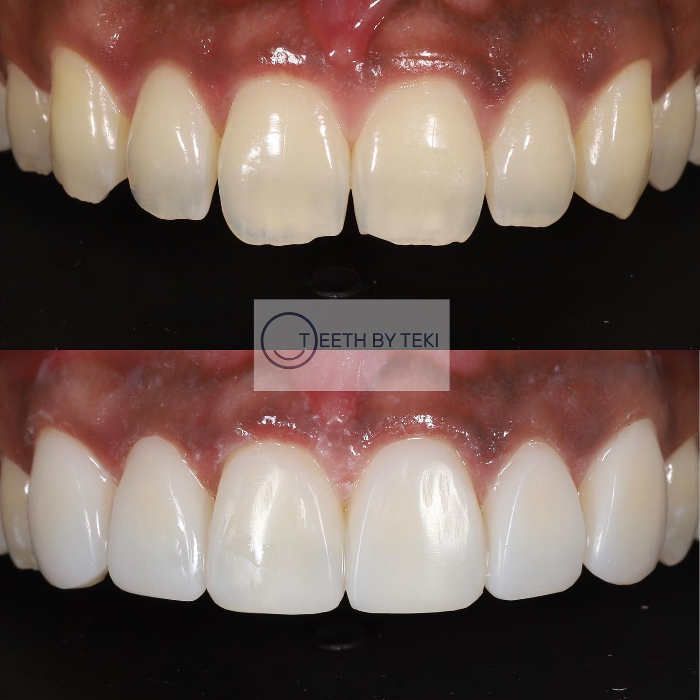 Composite bonding on 6 teeth 💙
.
.
No drilling, no injections. Keeping it simple
.
.
Composite if looked after well can last 5-7 years
.
.
Existing patients don’t forget to book your maintenance appointment 🧼
.
.
New patients- we are booking into next year now so email book@teethbyteki.com and see you soon 💫
.
.
Dentists to learn the workflow and a simplified technique @trained_by_teki 💙