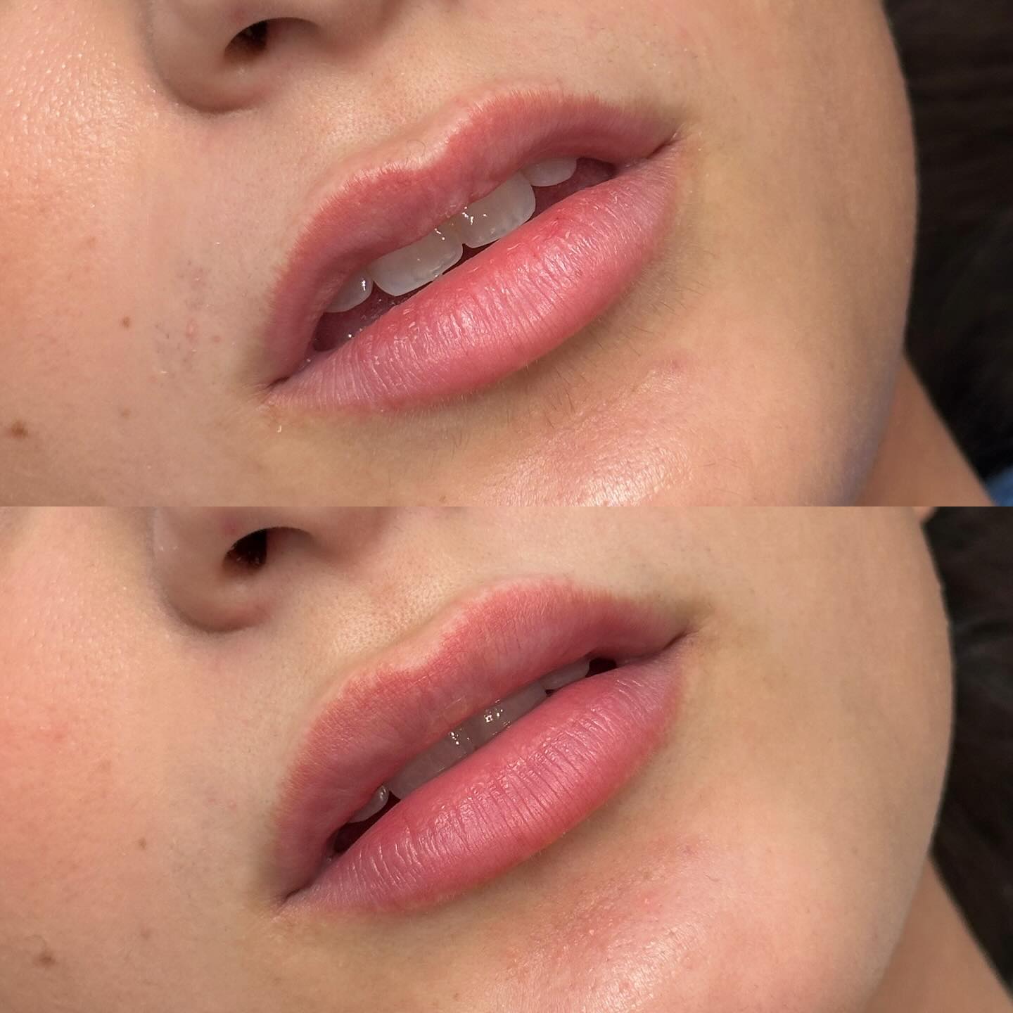 Let’s talk lips!💋 “Getting lip filler” is not one size fits all. There are so many ways that this treatment is customized and with that, you can have two separate treatments with wildly different results. This young, first time patient wanted lip volume but had never heard terms like M-Shape or hydrophobic as they related to treatment. With thorough assessment and conversation about her anatomy and her goals, the patient had a full understanding of the best approach to building her lip volume. We discussed the complexities of her lip shape and that best results would come through slow and steady building up of her shape. Though slow and steady can get us to great results, so can single sessions such as this before & after result. Our plan is to continue to refine and enhance, but shes thrilled with the improved appearance which focused more on structure, rather than size.