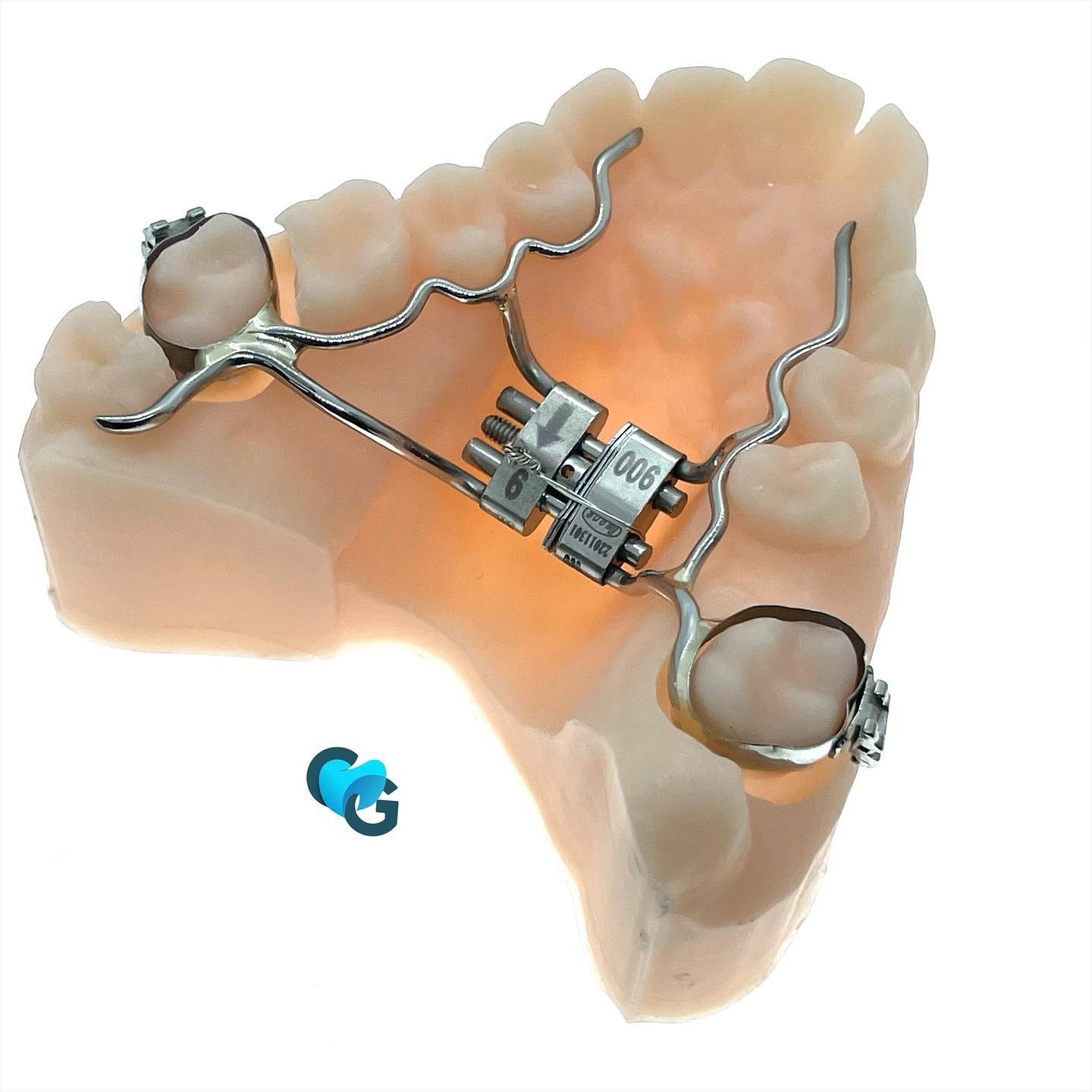 Leafexpander #leafexpander #expansion #expansionforcee #pression #orthofixe #orthodontie #orthodontic #orthopassion #ortho #leone #dental #labo #suturepalatine