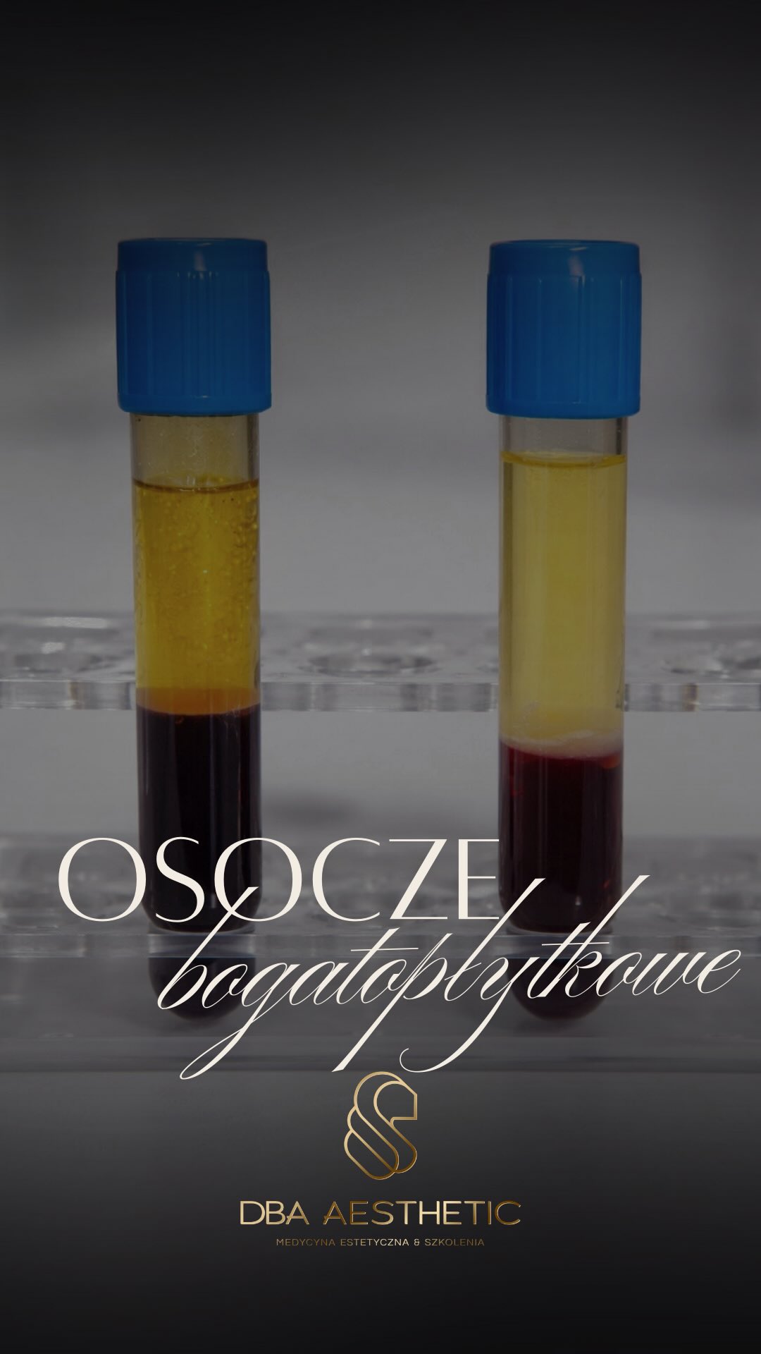 W medycynie regeneracyjnej liczy się jakość biologiczna, nie objętość.
I to jest różnica między zabiegiem „technicznym” a zabiegiem opartym na fizjologii.
Skuteczność zabiegu nie zależy od tego, ile ml podamy, tylko co realnie znajduje się w tej frakcji. Dlatego w praktyce klinicznej mniejsza objętość osocza bogatopłytkowego często daje lepszy efekt niż duża ilość osocza ubogiego w płytki.
#medycynaestetyczna #szkoleniamedycynaestetyczna #pracujzpasją