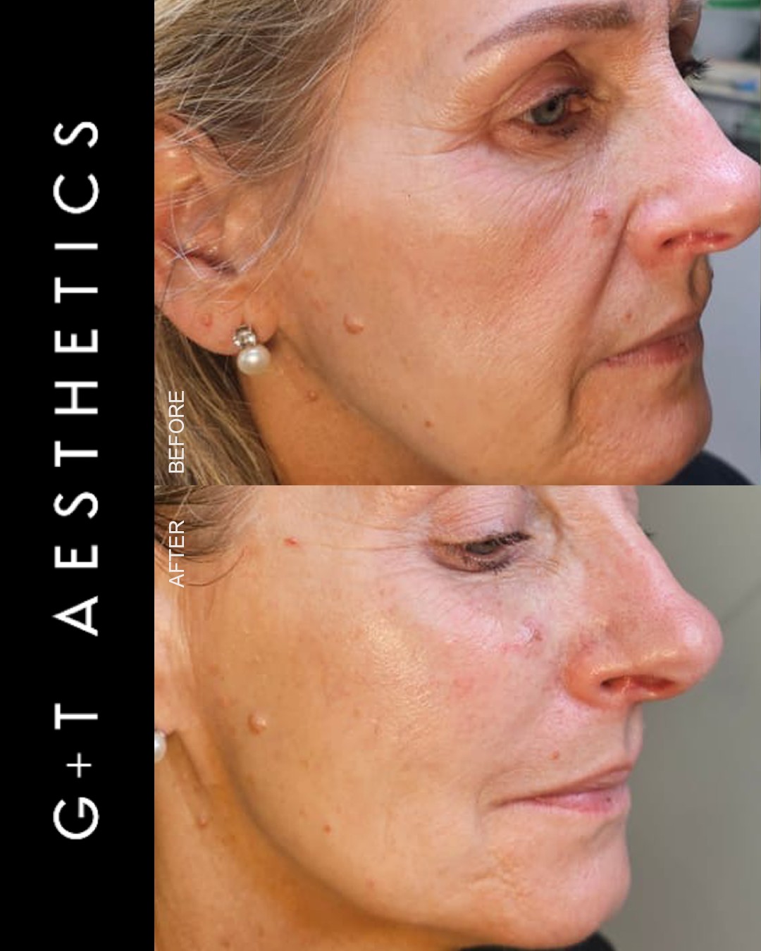 Lifted, plumper, more defined ✨
Cheek dermal fillers restore volume and enhance natural contours for a refreshed, youthful look.
📲Enquire or visit www.gtaesthetics.co.uk for more info.
#CheekFillers #DermalFillers #FacialRejuvenation #AestheticClinic #StamfordAesthetics #BeforeAndAfter