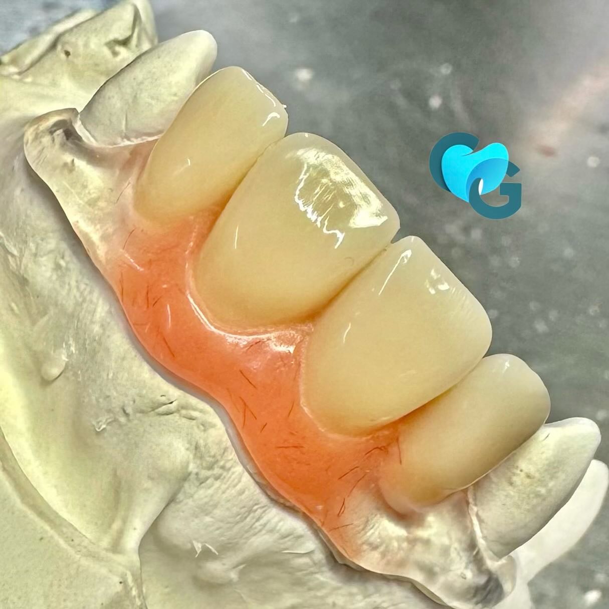 #valplast #partielnylon #partielprovisoir #partiel #dentaire #dent #dentsuisse #techniquedentaire #laboratoiredentaire # tenchiquedentaire #reconstitutiondentaire #vita #resine #sourire #bonmoral #bouche #amovible #estethique