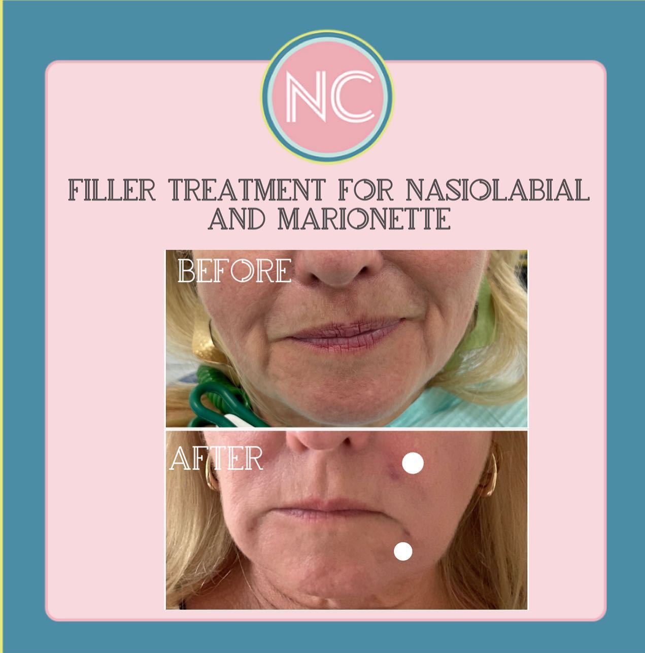 ☺️Nasiolabial and Marionette filler treatment to provide a natural look
🖥 website www. nickcoller.co.uk
❤️ Nicholas Coller method of Natural refinement
.
.
.
.
.
.
#fillertreatment #nasiolabialfillerlondon #marionnettefiller #cosmeticinjectables #cosmeticinjector #wapping #stkatharinedocks #shadwell #lipfillerslondon #lipfiller #fillerbeforeandafter #juvederm #restylane #facialaesthetics #wappingbeauty #shadwellbeauty #canarywharfbeauty
