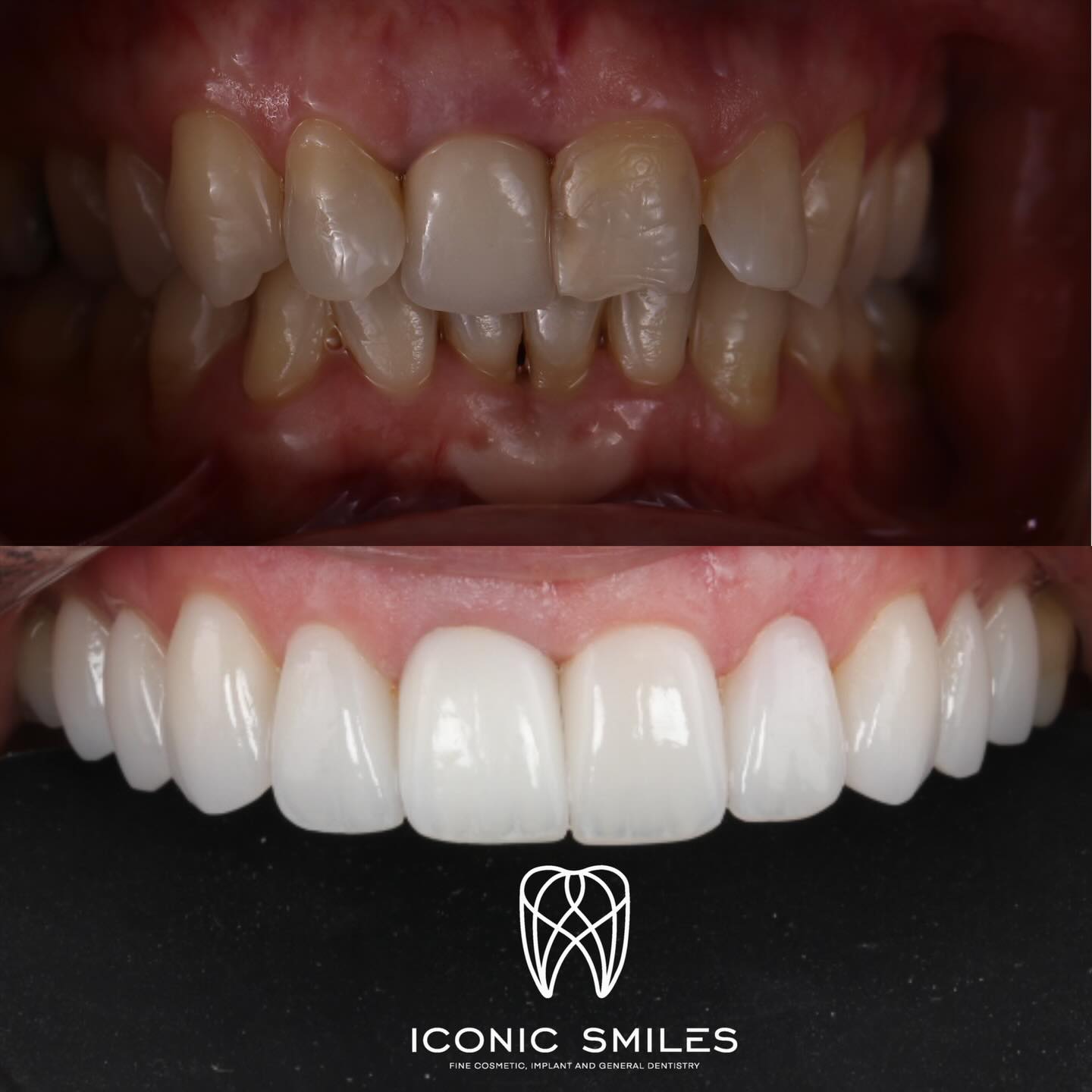 🌟Porcelain Veneers 🌟
Porcelain veneers are not all the same! We have added natural details to the veneers and a glass like finish to the veneers to finish with this rejuvenating smile.
DISCLAIMER
All information provided by Dr Matthew El Azzi - DEN0001996783, Registered Dentist, is for general and educational purposes only. It does not constitute medical advice and should not be relied upon as a substitute for professional consultation.
Images and videos are of real patients who have given consent. No filters, AI enhancements, or unrealistic lighting are used. These materials are intended to demonstrate examples of treatment but do not guarantee results. Individual results, risks, potential complications, and recovery times vary between patients.
Patient stories are individual experiences and should not be interpreted as indicative of expected outcomes for all patients. Your experience may differ.
Before commencing any treatment, you should seek independent advice from a qualified, AHPRA-registered health practitioner and consider obtaining a second opinion.
For details about each specific treatment, head to:
https://www.iconicsmiles.com.au
Dr Matthew El Azzi - DEN0001996783
Registered Dentist, General Registration