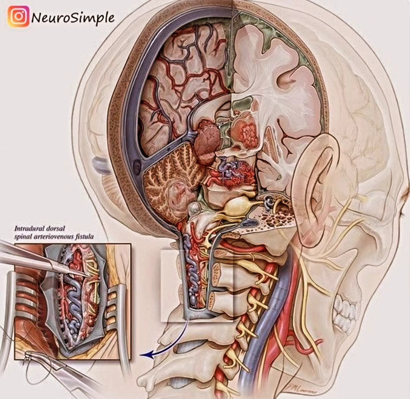 Tem uma técnica de terapia manual em puxo a orelha do paciente "literalmente", kkk mas puxo pensando em soltar toda a fáscia (tecidos dessa região).
Quando "puxo a 👂" , puxo pensando em tudo isso que está conectado.
Atingindo até o tecido cerebral.
E o paciente sempre sai da sessão mais tranquilo. De certa forma, a técnica ajuda a melhorar o sistema nervoso do paciente.
.
.
.#dorcrônica #terapiamanual #osteopatia #osteopatiasp #ipiranga #dorquadrilecoluna #sistemanervoso #zumbido #vertigenscervicogênicas