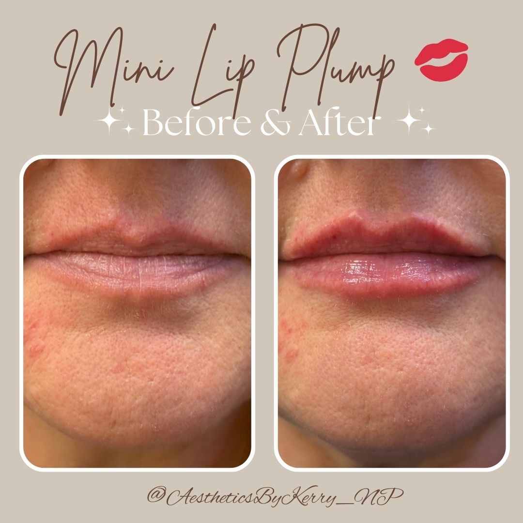 I can’t get over these lips 🤍
Soft. Balanced. Still you.
This is what intentional lip filler looks like! 💋
Booking link in bio ✨
.
.
.
#subtlelips #naturalenhancement #perfectpout #southfloridainjector