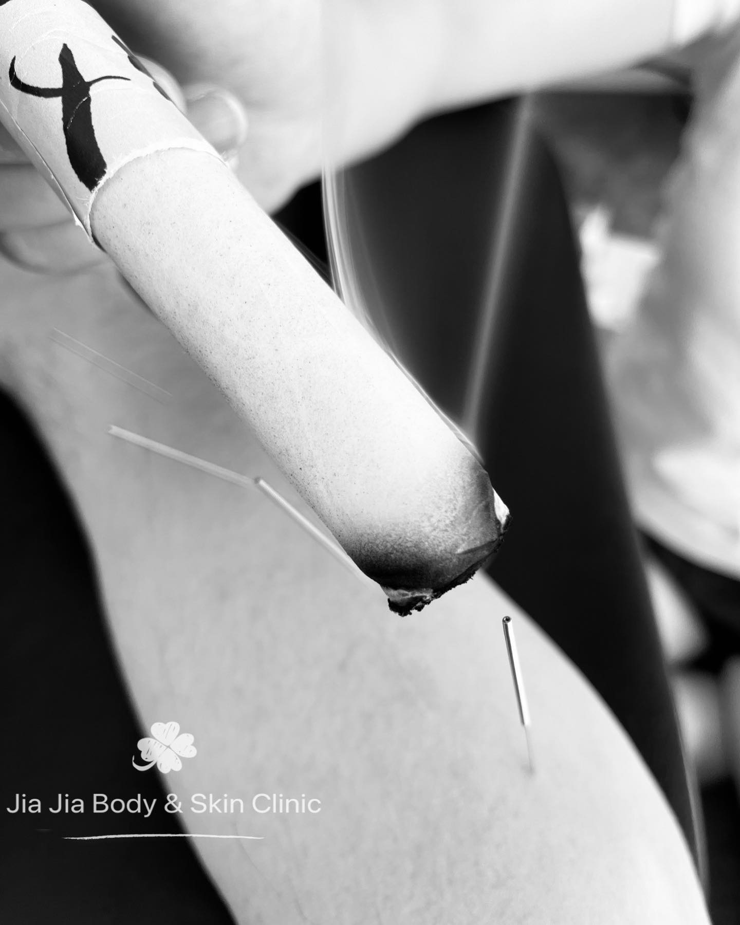 Acupuncture is an ancient medical practice, originating in China more than 2,000 years ago. It uses metal needles to stimulate points in the body, often with the addition of manual manipulation, heat or electrical stimulation. Some practitioners use lasers instead of needles to stimulate the acupuncture points.
#acupuncture
#moxa
#chinesemedicine