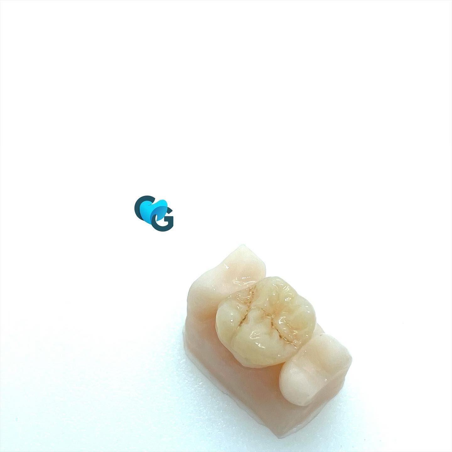 Onlay composite #composite #teeth #inlay #onlay #fixe #dental #dent #dentiste #labodentaire