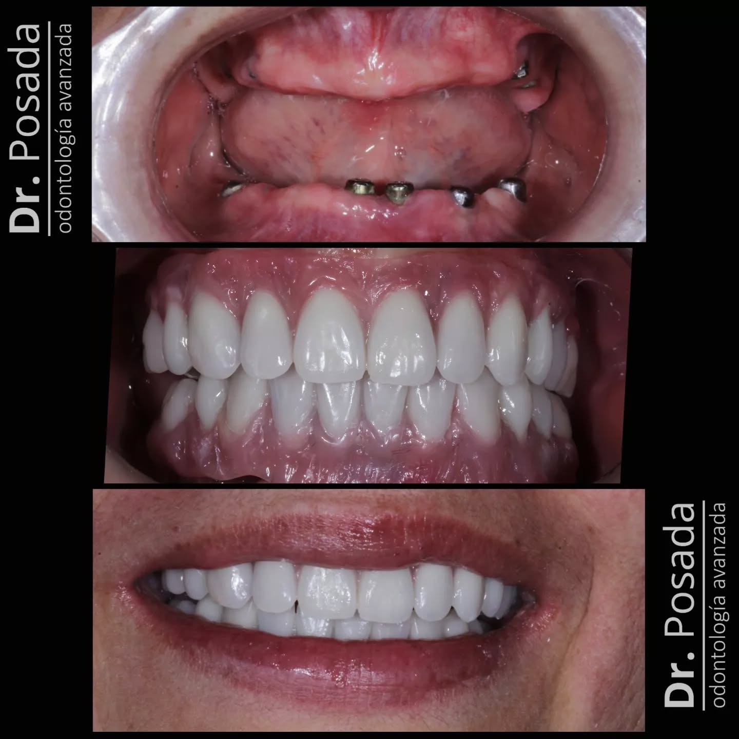 Los #implantes dentales 🔩cambian vidas… 🤩en este caso realizamos 2 prótesis hibridas que son prótesis que se atornillan completamente sobre implantes que colocamos en el hueso de manera guiada por computador, de ésta manera el paciente puede volver a tener una sonrisa #bonita y una función adecuada de manera fija y sin tener que retirar ningún tipo de aditamento de su boca.🦷😁🔝🔝🔩
.
.
.
.
✔☎️ 601 755 20 46
✔📲 +57 304 652 90 22
🦷🇨🇴🔝🦷🇨🇴🔝🦷🇨🇴🔝🦷🇨🇴🔝🦷🇨🇴.
.
.
.
.
.
.
.
.
.
.
.
.
.
#implantes #cambiandovidas #antesydespues #prosthodontics #protesisdental #rehabilitación #odontologobogota #chiconorte #odontologiaavanzada
#odontologobogota #sonrie #protesishibridasobreimplantes
