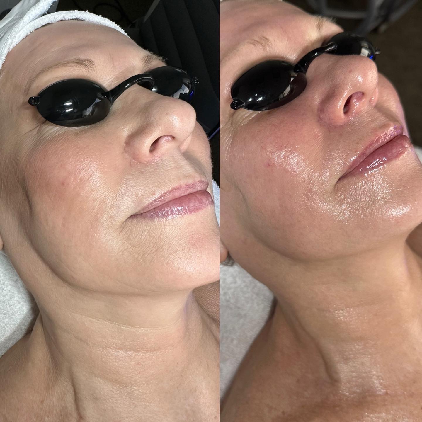 🌟The Hydrafacial glow is real 🌟
Book now before valentines so your skin looks amazing on your date with your sweetheart. 😍
Online booking available @idealskinandhealth.com