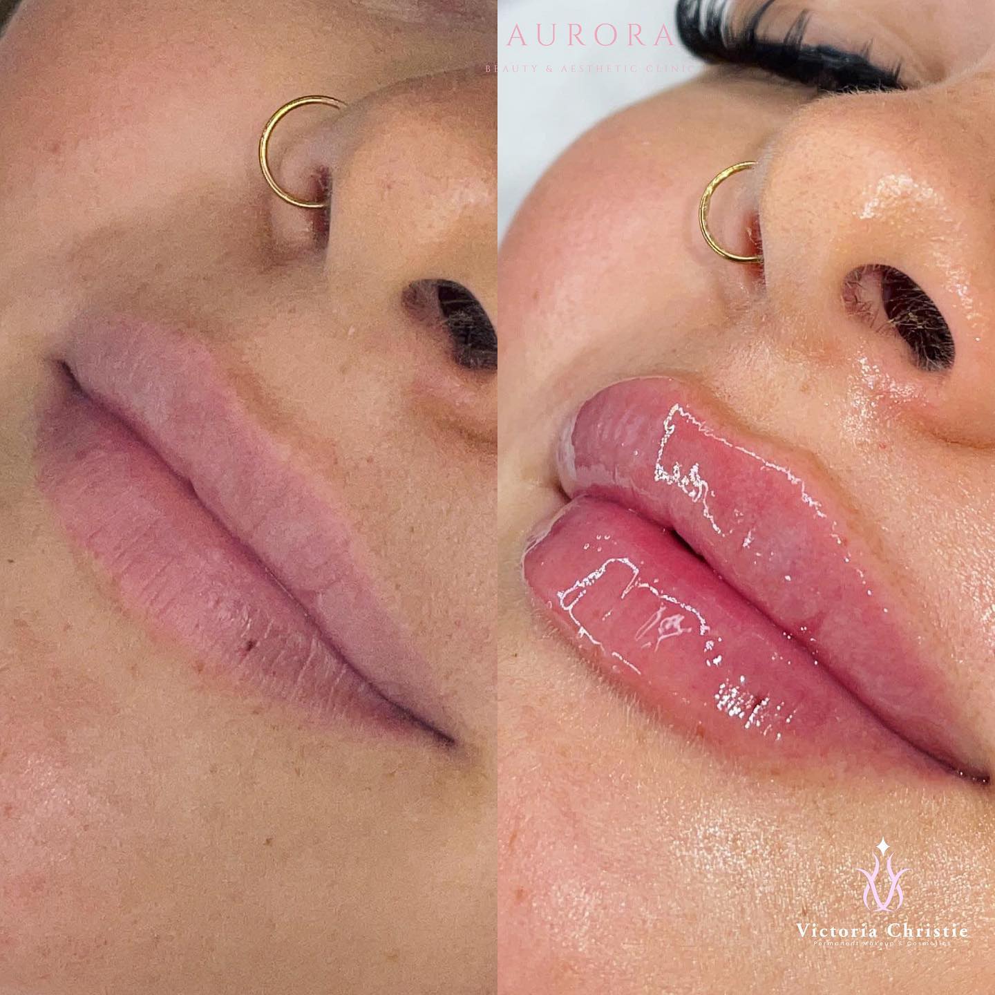 AURORA LIPS 👄
1ml £180
Revolax
DM to book 💗