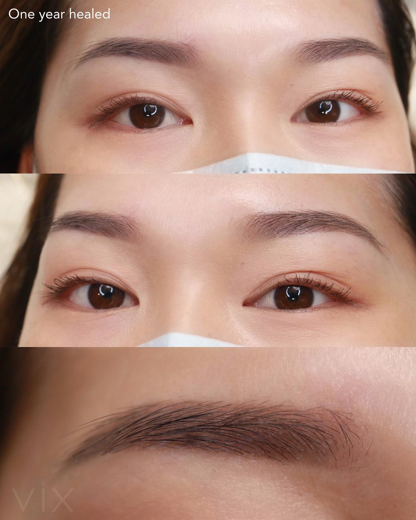 One year healed brows! My client has been coming to me since I was a noob in 2020 🥹 I have since improved so much! thankful for all my clients who trusted me from the beginning!
🤍 Info & ONLINE BOOKING: www.vixcosmetictattoo.com
📍Bay Area (Burlingame)
🤎 Specializing in ombré powder brows.
‼️Previous tattoo work needs to be approved first.
——
INFO:
• Pain level: 3/10
• Duration of appointment: 2 hours
• Healing time varies but average 2 weeks
• Lasts: 1-3 years depending on skin type and lifestyle.
.
.
.
#pmu #permanentmakeup #ombrepowderbrows #powderbrows #sanfranciscopmu #microbladingsanfrancisco #sanmateobrows #pmuartist #sanmateopmu #bayareapmu #bayareabrows #sflashes #bayarealashes #oaklandbrows #oaklandlashes #browtattoo #browartist #millbraebrows #SanFranciscomicroblading #bayareatattoo