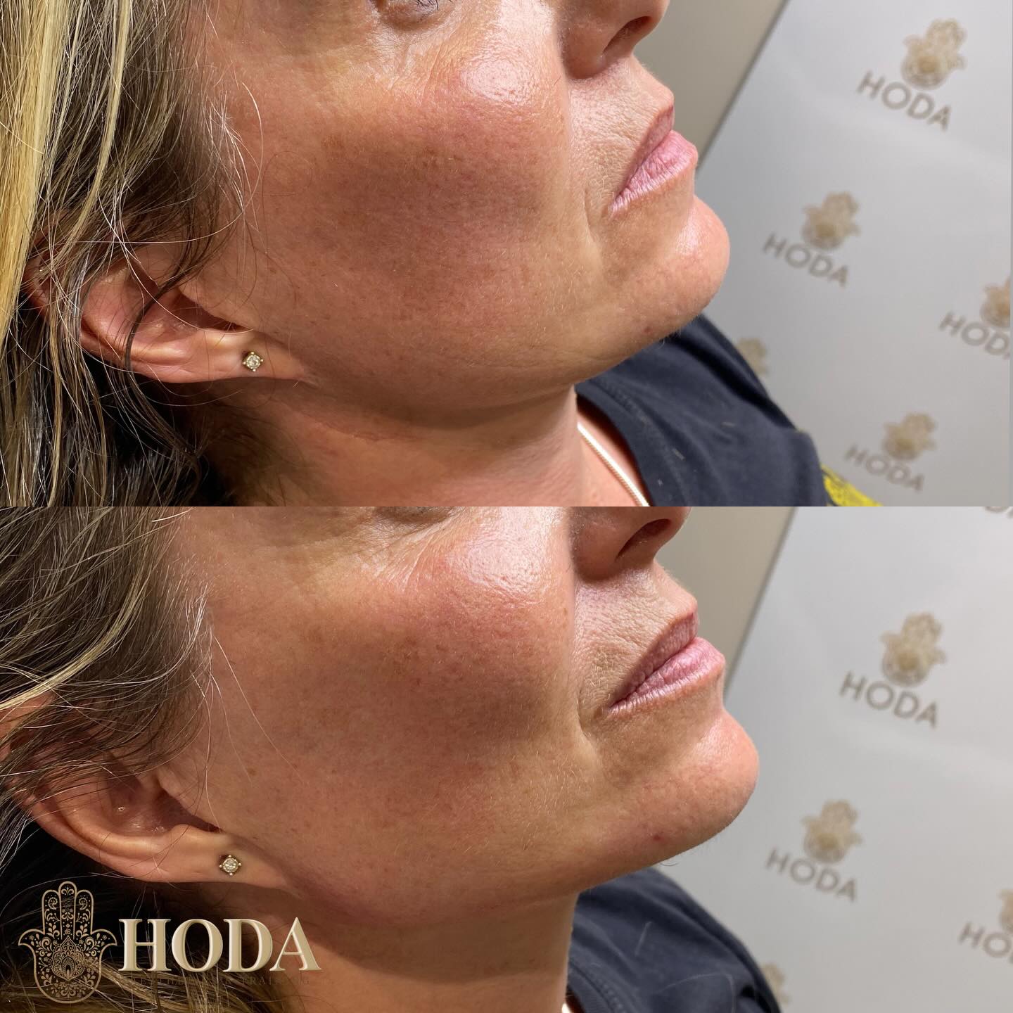 Jawline filler before & after โจ
A little structure can make a big difference โ for the right candidate.
Jawline filler is great for enhancing definition, supporting the lower face, and creating a more balanced profile. In this before-and-after, you can see how subtle filler placement helps sharpen the jawline, smooth the lower face, and give a more sculpted look without appearing overdone.
That said, jawline filler isnโt for everyone. The best candidates are those who have:
โข Mild to moderate loss of jawline definition
โข Early jowling or skin laxity
โข A naturally softer or less defined jaw
โข Good skin quality and realistic expectations
The goal is never to change your face โ itโs to enhance whatโs already there and keep results looking natural and proportionate.
Results shown are immediately after treatment and will continue to refine as swelling settles.
Curious if youโre a good candidate?
๐ฒ DM book with Hoda
๐ฉ๐ผโโ๏ธ Nurse Led-Aesthetic Clinic
๐ Bournemouth, Dorset
#jawlinefiller #fillerbournemouth #bournemouthsalon #dorsetaesthetics #bournemouthbeauty
