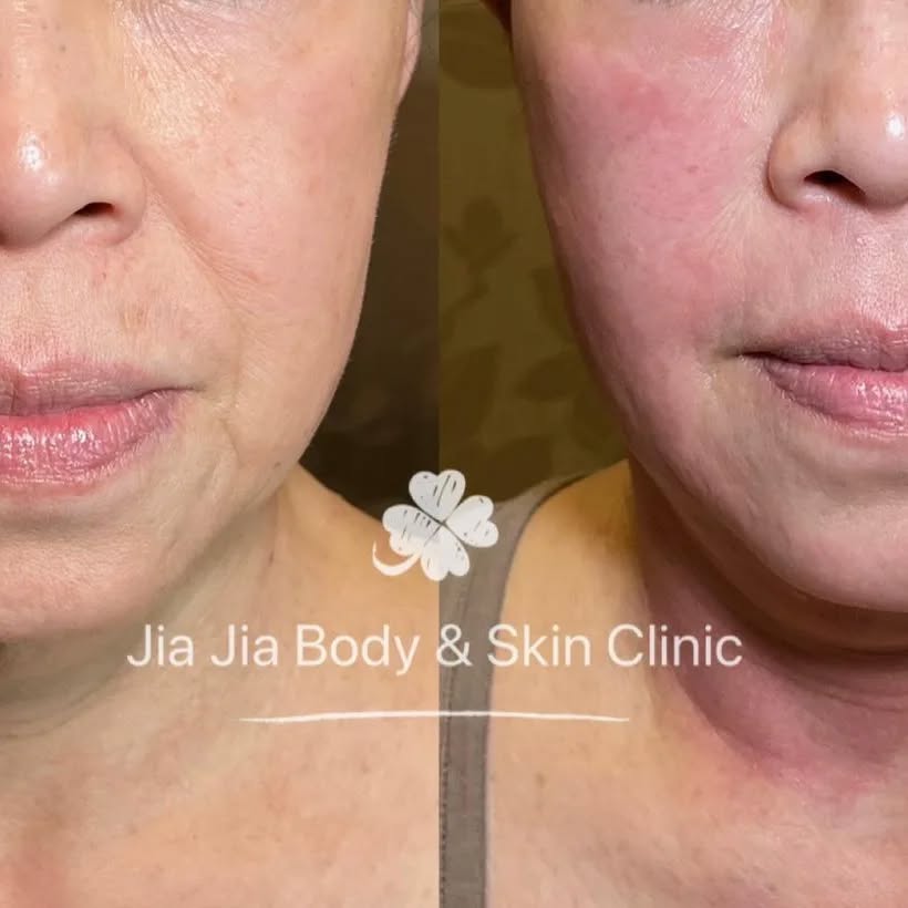 Before and immediately after laser treatment! š
You can see an obvious change in her face shape, nasolabial lines and fine lines.
ZOOM INš to see more! What a beauty!!
The redness comes from the stimulation from the laser and it calmed down with an hour!!! almost no down time!!
#skinrejuvenation #almalaser #skincare #spa #sculpting #beauty #laser #nir #skinscience #clearlift #lifting #tightening #iloveskincare
