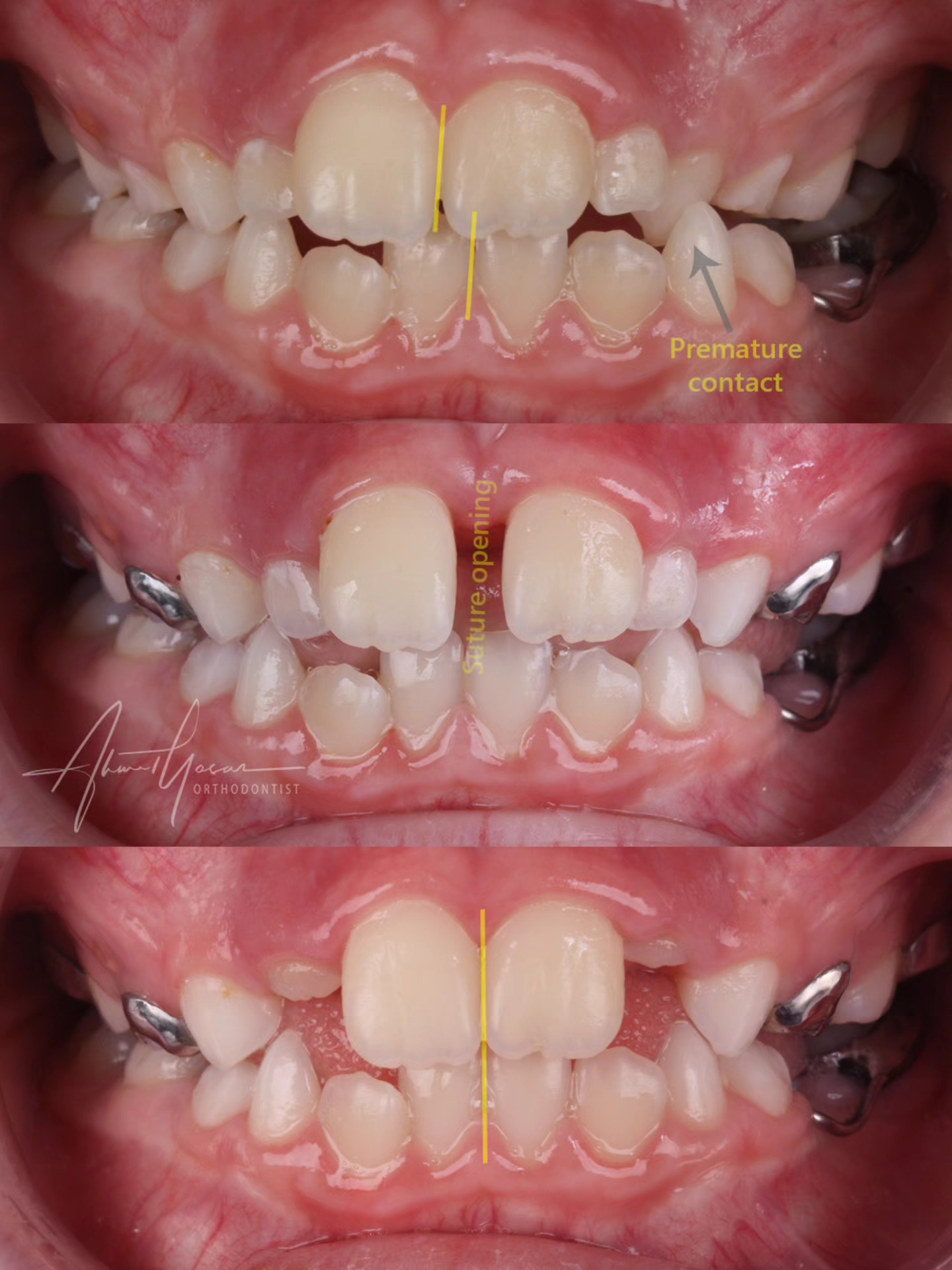Functional mandibular shift due to the premature contact on milk canines. Rapid maxillary expansion (RME) can solve premature contact, midline discrepancy and narrow upper arch.
.
Üst çene darlığı ile birlikte süt köpek dişlerinde erken temasa bağlı olarak alt çenede yana kaymalar görülebilir. Hızlı üst çene genişletmesiyle alt çenenin fonksiyonel kayması düzeltilebilir. Bununla birlikte çene darlığı ve orta hat sapması da düzeltmek mümkün bu şekilde.
.
Our clinic is authorized by the Ministry of Health of the Republic of Türkiye for International Health Tourism. All patients have been informed and have provided consent for the use of their photographs on our social media platforms. All content shared on social media is intended to inform patients about procedures and should not be perceived as advertising. Outcomes of any surgical or interventional treatment may vary from person to person. It is recommended to consult your physician for detailed information before undergoing any procedure.
.
.
#ortodonti #ortodontist #bursa #bursaortodonti #bursaortodontist #bursaortodontiuzmanı #orthodontics #braces #teltedavisi #dişteli #orthognathicsurgery #invisalign #clearcorrect #şeffafplak #lingualortodonti #dişteli #çeneameliyatı #selfligating #kapaklıbraket #gülüştasarımı #dent #dentistry #photography #estetik #dentalart #ahmetyasar #drahmetyasar