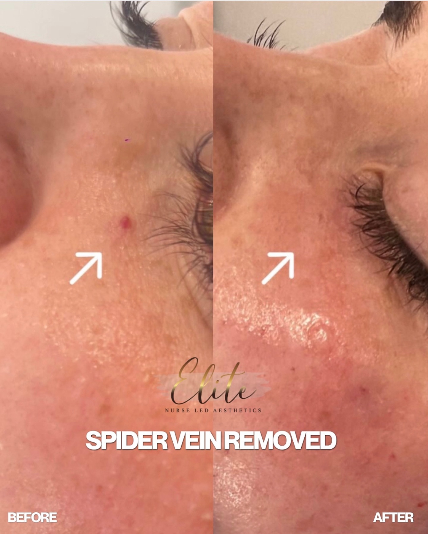 🖊️ Spider Vein Removed ✨
Small detail. Big confidence boost.
If spider veins are something you’ve been feeling self-conscious about, you’re not alone — and the good news is, they can be treated quickly and effectively.
🩺 What are spider veins?
Spider veins are small, visible blood vessels that appear close to the surface of the skin, commonly on the legs or face. They’re harmless, but many people choose to treat them for cosmetic reasons.
💉 How are they treated?
At Elite Nurse Led Aesthetics, we use precise, medically-led techniques to safely reduce the appearance of spider veins. The treatment targets the vein directly, allowing it to fade naturally over time — leaving the skin looking clearer and more even.
✨ Why choose treatment?
• Minimally invasive
• Quick procedure
• No surgery required
• Improves skin appearance and confidence
📍 Wakefield
📞 Book your consultation today and take the first step towards smoother, clearer skin.
#EliteNurseLedAesthetics #WakefieldAesthetics #SpiderVeinTreatment #AdvancedSkinCare #ConfidenceStartsHere