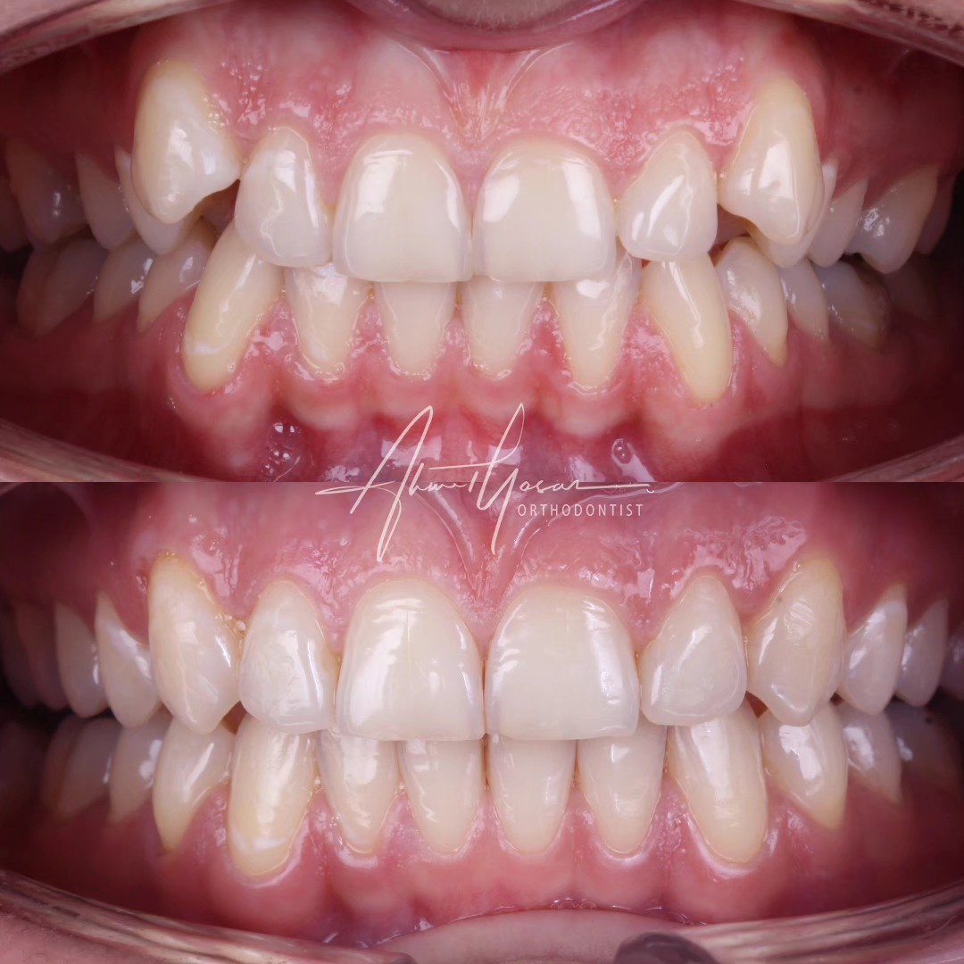 Aligners / şeffaf plak.
.
Our clinic is authorized by the Ministry of Health of the Republic of Türkiye for International Health Tourism. All patients have been informed and have provided consent for the use of their photographs on our social media platforms. All content shared on social media is intended to inform patients about procedures and should not be perceived as advertising. Outcomes of any surgical or interventional treatment may vary from person to person. It is recommended to consult your physician for detailed information before undergoing any procedure.
.
.
.
#ortodonti #ortodontist #bursa #fsm #bursaortodonti #bursaortodontist #bursaortodontiuzmanı #orthodontics #braces #teltedavisi #orthognathicsurgery #invisalignbursa #şeffafplak #lingualortodonti #dişteli #çeneameliyatı #selfligating #kapaklıbraket #gülüştasarımı #dent #dentistry #photography #estetik #dentalart #ahmetyasar #drahmetyasar