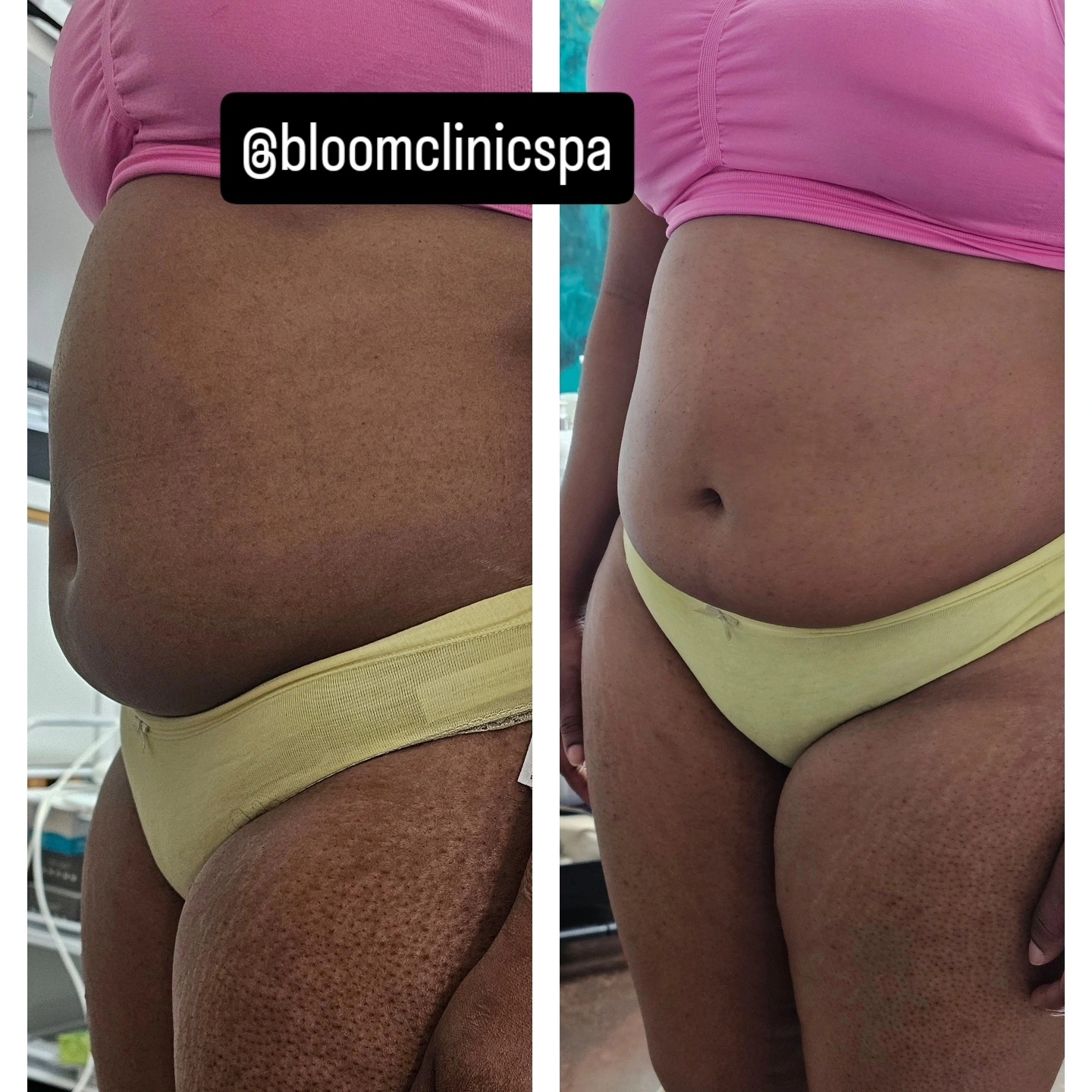This lady came to me today asking for help with her persistent and troublesome bloating, which was unlikely diet/ lifestyle related. She is diagnosed with PCOS which could be the underlying cause.
I performed deep colon massage along with Abdomnial Manual lymhatic drainage and worked with her ribcage and diaraphgram, which presented lots of resistance and tightness. She straight away reported release and how lighter she felt. Look at the abdominal definition we created as' side effect ' of only 1 session !!! 🤩. Coming back for more !
#manuallymphdrainage
#colonmassage