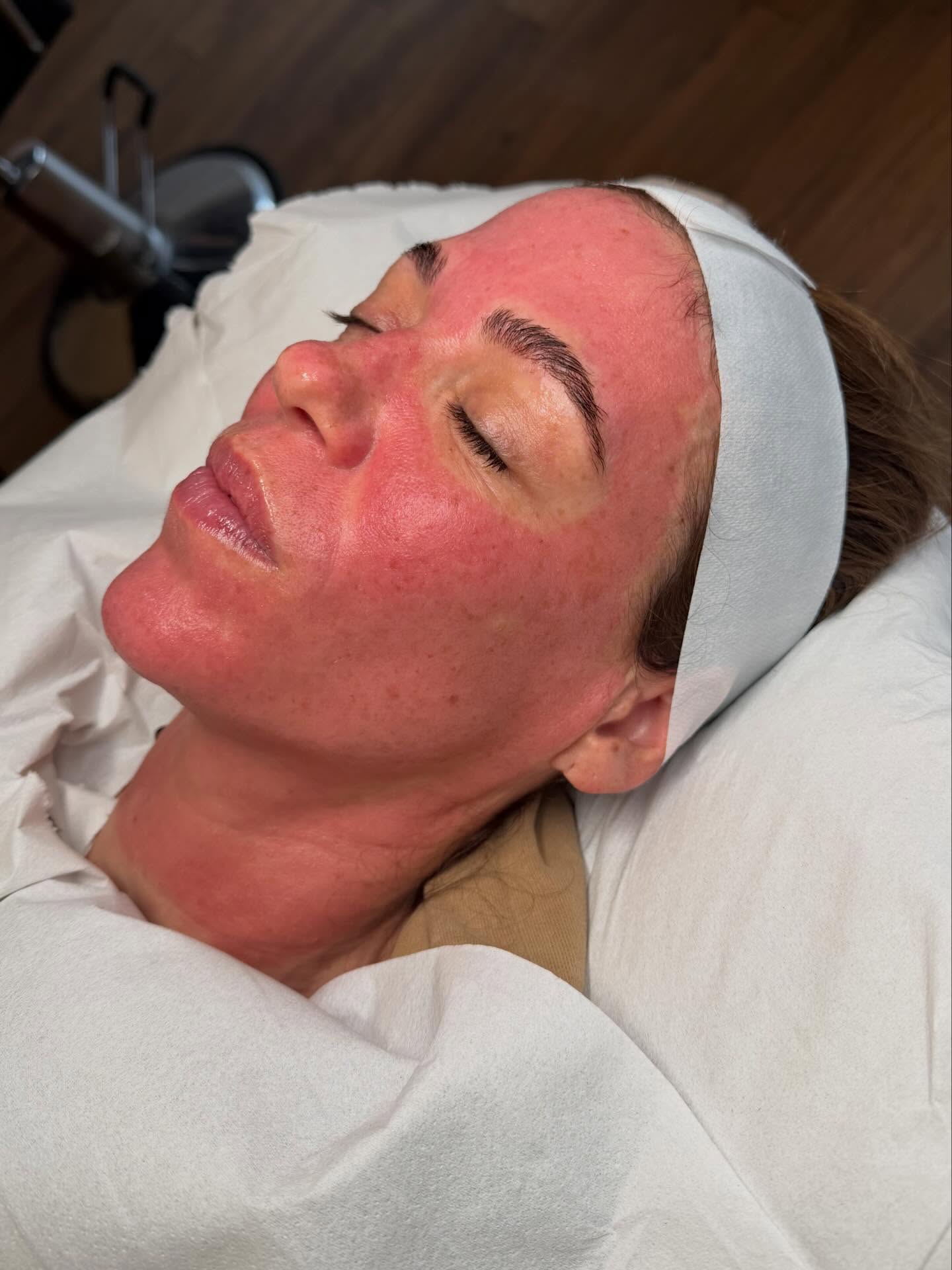 If I don’t look like this straight after microneedling.. I don’t want it 🤩
The collagen that will be produced from this.. just 😮💨👌🏽
This redness will mostly have gone within 24 hours, but the glow will remain ✨