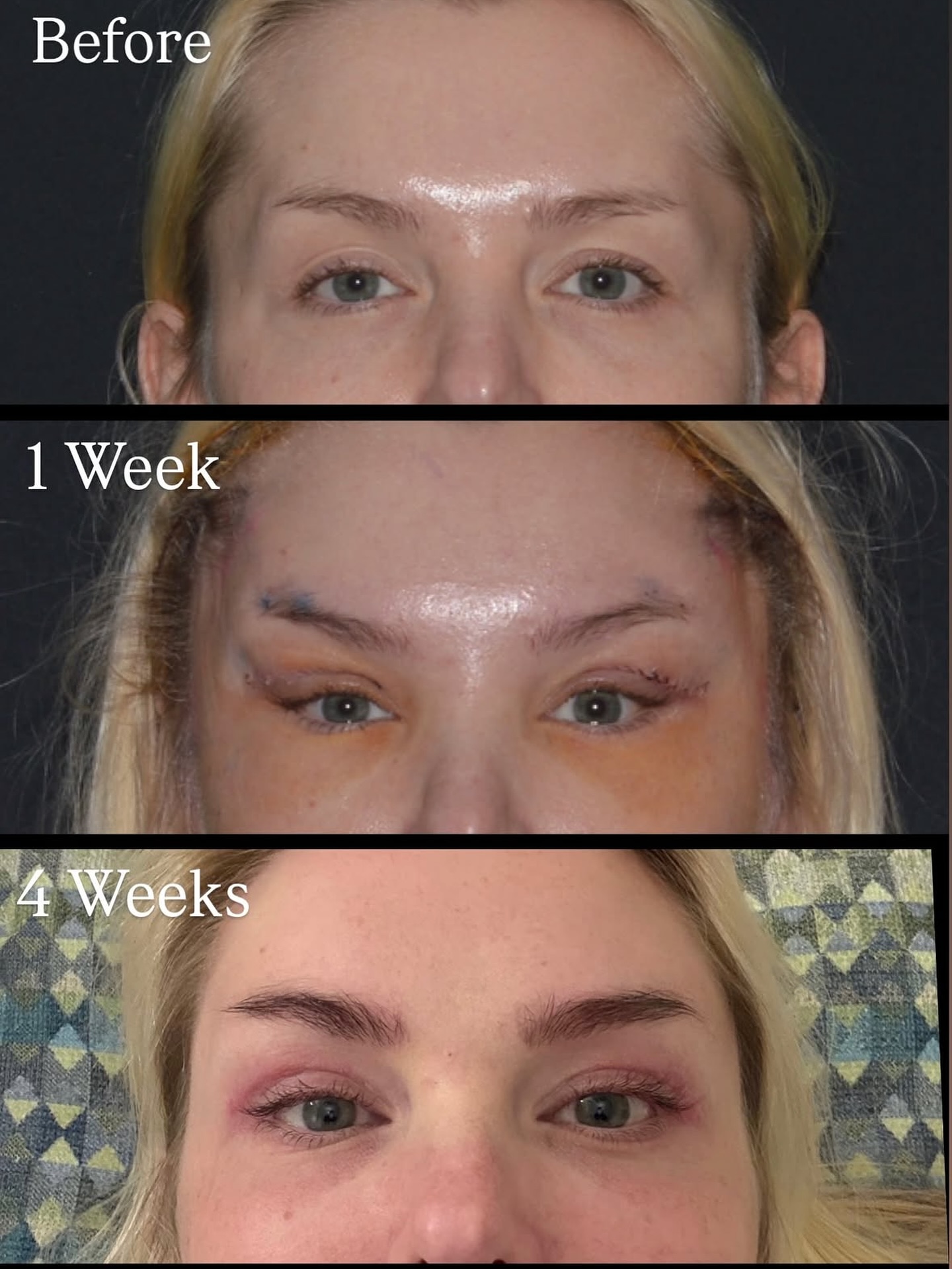 Temporal lift - így változik a műtét utáni hetekben.💓
A temporal lift finoman megemeli a szemöldök külső részét és a halánték területét,
így a tekintet nyitottabbá, fiatalosabbá válik.
Természetes hatású, látványos, gyors felépülési idővel.☝🏼
📩 Kérdésed van a folyamatról vagy a beavatkozásról? Írj nekünk privátban vagy jelentkezz konzultációra!
#esteworld #esteworldmagyarorszag #temporallift #szemöldökemelés