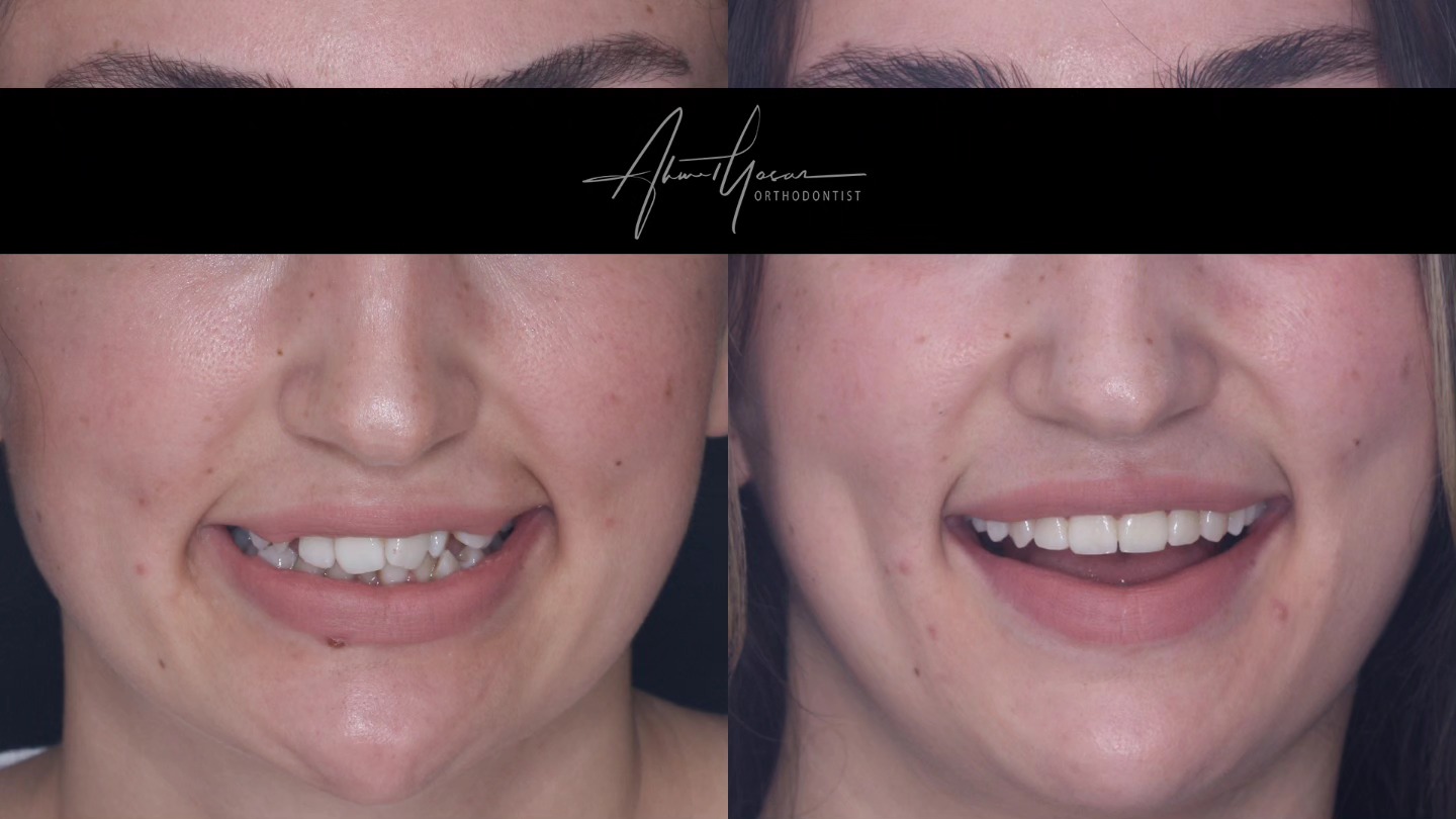 Şeffaf plak tedavisi / Clear aligners
.
Our clinic is authorized by the Ministry of Health of the Republic of Türkiye for International Health Tourism. All patients have been informed and have provided consent for the use of their photographs on our social media platforms. All content shared on social media is intended to inform patients about procedures and should not be perceived as advertising. Outcomes of any surgical or interventional treatment may vary from person to person. It is recommended to consult your physician for detailed information before undergoing any procedure.
.
.
.
#ortodonti #ortodontist #bursa #bursaortodonti #bursaortodontist #bursaortodontiuzmanı #orthodontics #braces #teltedavisi #dişteli #orthognathicsurgery #invisalign #clearcorrect #şeffafplak #lingualortodonti #dişteli #çeneameliyatı #selfligating #kapaklıbraket #gülüştasarımı #dent #dentistry #photography #estetik #dentalart #ahmetyasar #drahmetyasar