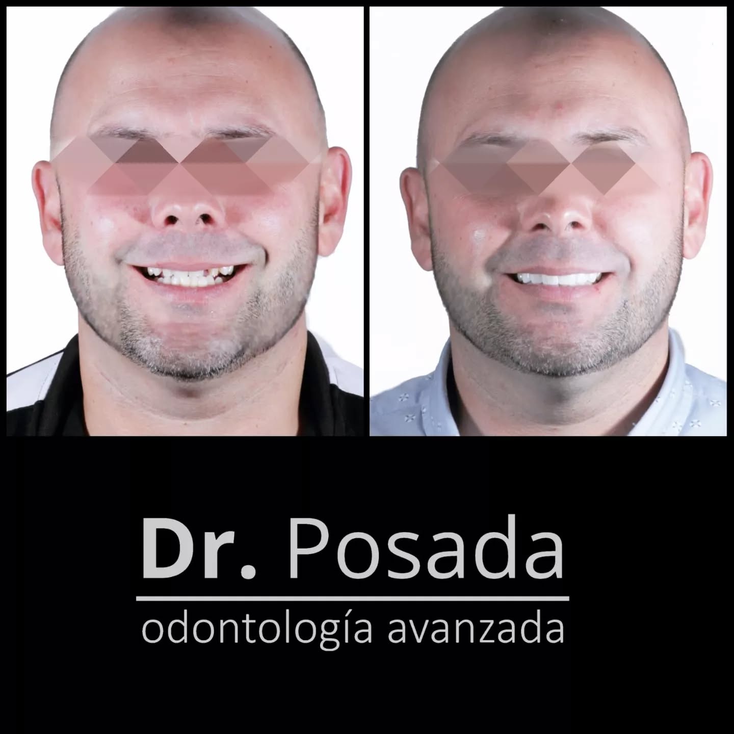 Patient visiting us from #miami for his ceramic venners smile makeover
.
.
.
.
.
.
.
.
📲 +57 304 6529022
☎️ 601 7552046
.
.
.
.
.
.
.
#diseñodesonrisa #venners #ceramicveneers #naturalsmile #friday #pacientefeliz #bogota🇨🇴 #colombia🇨🇴