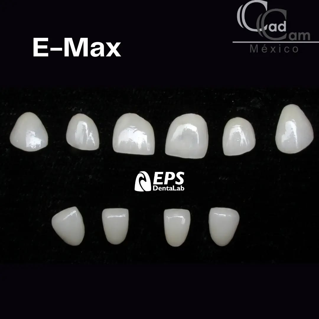 En el arte de la odontología estética, las carillas desempeñan un papel crucial, y en @EPSLAB, elevamos esta experiencia a nuevas alturas con nuestras carillas en el renombrado material E-Max. La Firma de @EPSLAB: En el mundo de la odontología estética, @EPSLAB se destaca como una referencia en la creación de carillas excepcionales en E-Max. Nuestra dedicación a la perfección estética y funcional nos ha ganado el reconocimiento por ofrecer resultados que superan las expectativas. - - - Aviso de responsabilidad: Todas las fotos publicadas en esta cuenta de Instagram son propiedad intelectual de Estudio de Porcelana Suizo S.A de C.V. y están protegidas por derechos de autor #CadCam #Mexico #implantologia #implantesdentales #dentistry #dentista