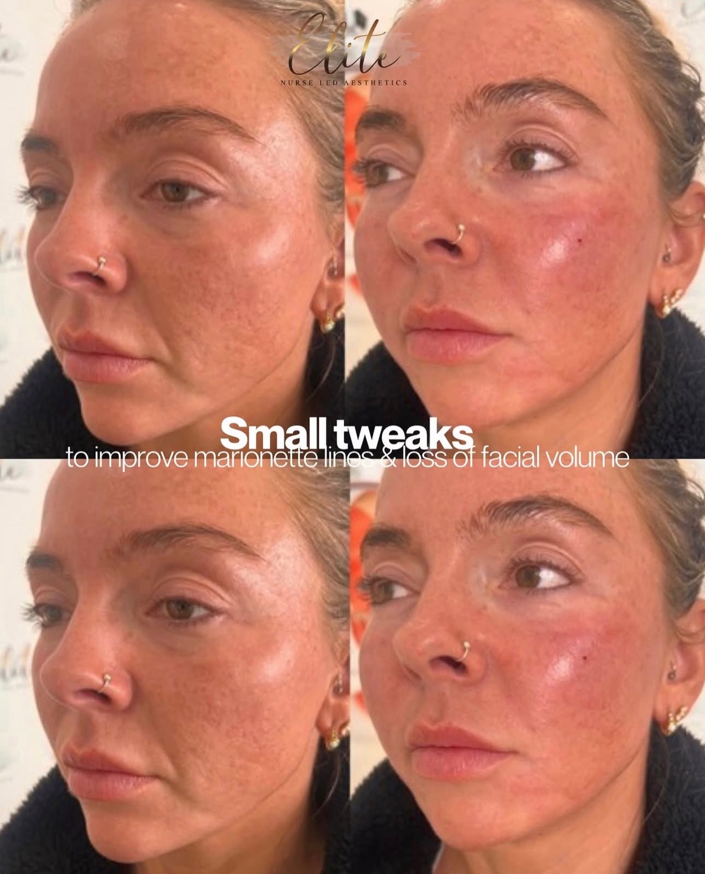 Subtle enhancements, beautiful results 💉✨
Small tweaks can make all the difference — by softening marionette lines and restoring lost facial volume, we bring back balance and a youthful, refreshed look.
It’s all about enhancing your natural beauty, not changing it 💫
📍 Elite Nurse Led Aesthetics | Batley, WF17
💌 DM to book your consultation today and start your journey to confidence!
#EliteAesthetics #NurseLedClinic #FacialFiller #MarionetteLines #DermalFiller FacialRejuvenation