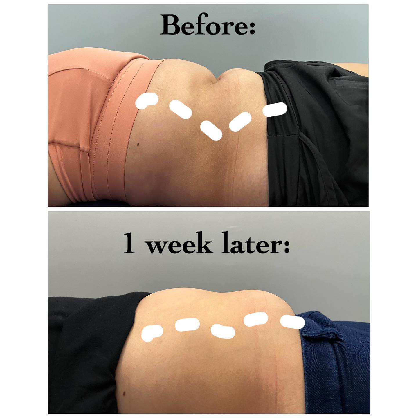 Habitual sucking in of tummy to “brace” the core can lead to pain or discomfort in neck, shoulder, and back.
Often, relearning how to breathe properly can help the tummy muscles relax, thereby reducing pain in those regions.
As an added benefit, breathing right can help your body look a lot better!
#exodusphysio #sgphysio #physiosg #strongerthanever #hougangphysio