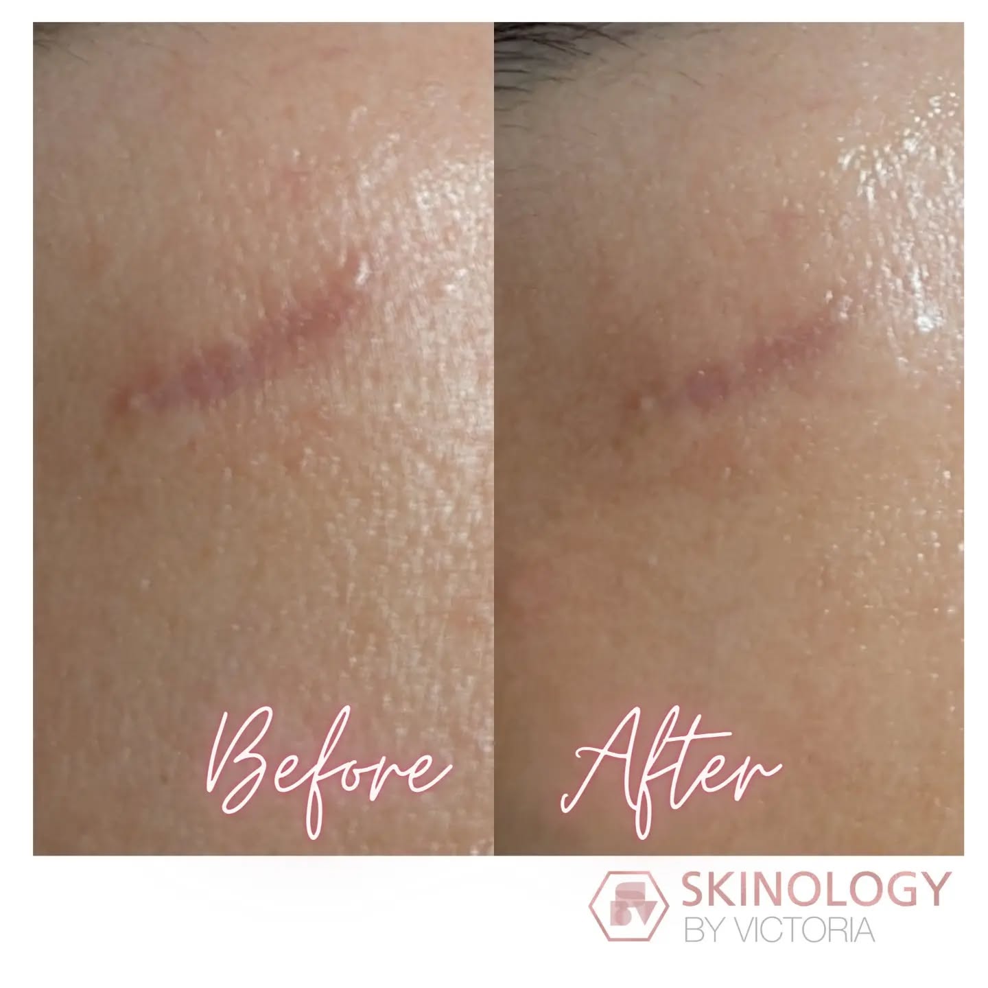 Absolutely amazing difference in this scar after just one custom skin treatment 🤯
I love what I do and the result you can get from using amazing ingredients and equipment.
#dermaluxled #allskinmed #growfactors #brentwoodskin #facialist