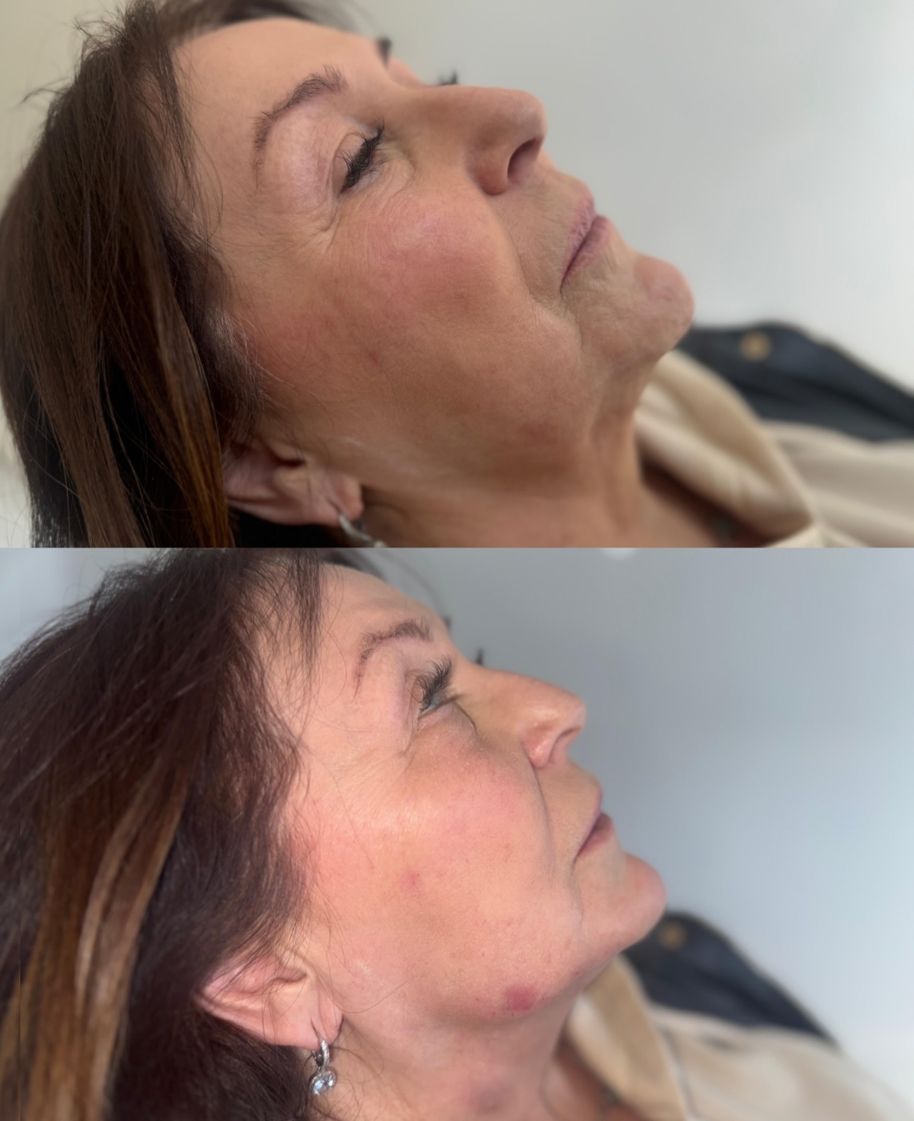 Ageing doesn’t happen in one place, it happens through loss of structure, support and collagen over time.
This transformation is about restoring what the face has gradually lost, not changing it.
No overfilling. No heaviness. Just intelligent placement and a full-face approach that respects natural anatomy.
By treating key areas across the lower face we were able to:
✅ Rebuild underlying support
✅ Improve facial balance and proportion
✅ Lift and soften areas affected by downward pull
✅ Create a rested, refreshed look that still feels completely like our patient
Every treatment plan begins with a full facial assessment. This isn’t about adding volume for the sake of it. It’s about restoring structure, harmony and confidence , subtly and safely.
If you’ve noticed changes in firmness, shape or definition and want results that look natural this approach is for you.
📍 Ultra Aesthetics
📲 Drop us a DM to book your consultation today