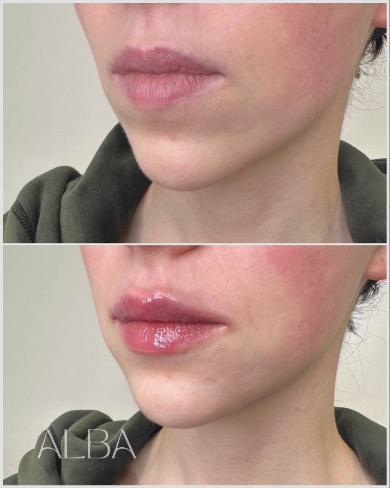 Natural lip enhancement for soft volume and hydration.
📍 22 Market Place, GL7 2NW, Cirencester
📞 01285 238070
#ALBASkinClinic #NaturalLips #LipEnhancement #DoctorLedClinic #SubtleResults