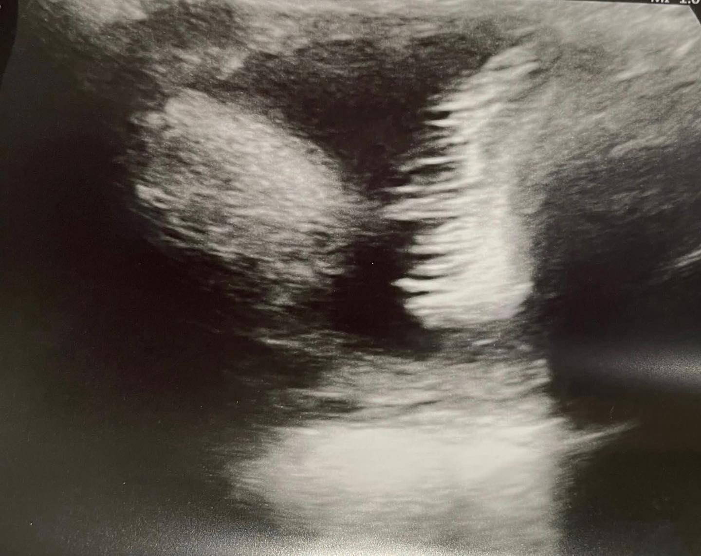 How amazing is this?! I accompanied one of my clients for her 36 week scan this week and we saw this!ā¦ā¦ Lovely long hairā¦.. floating in the amniotic fluid. Needless to say, a baby hair brush was quickly added to the hospital bag! š Canāt wait to see it.š #babyhair #continuity #privatemidwife