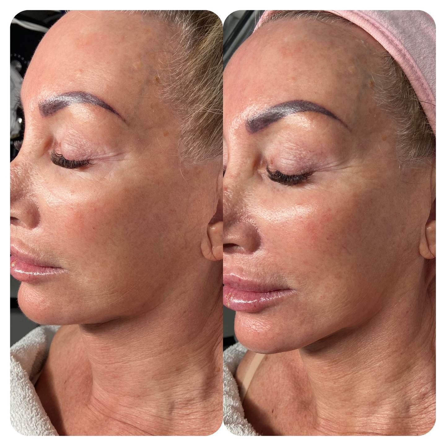 Real skin. Real change. Real confidence.
See how a single Million Dollar Facial can unlock your glow.
Ready to feel radiant? Book your consultation with Naz today. ✨
