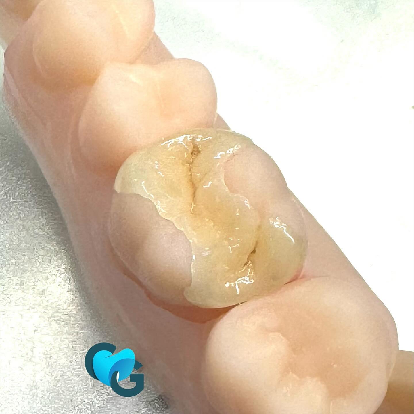 #onlay #inlay #composite #dent #couronne #dentaire #reconstitutiondentaire #labo #labodentaire #vita #emax