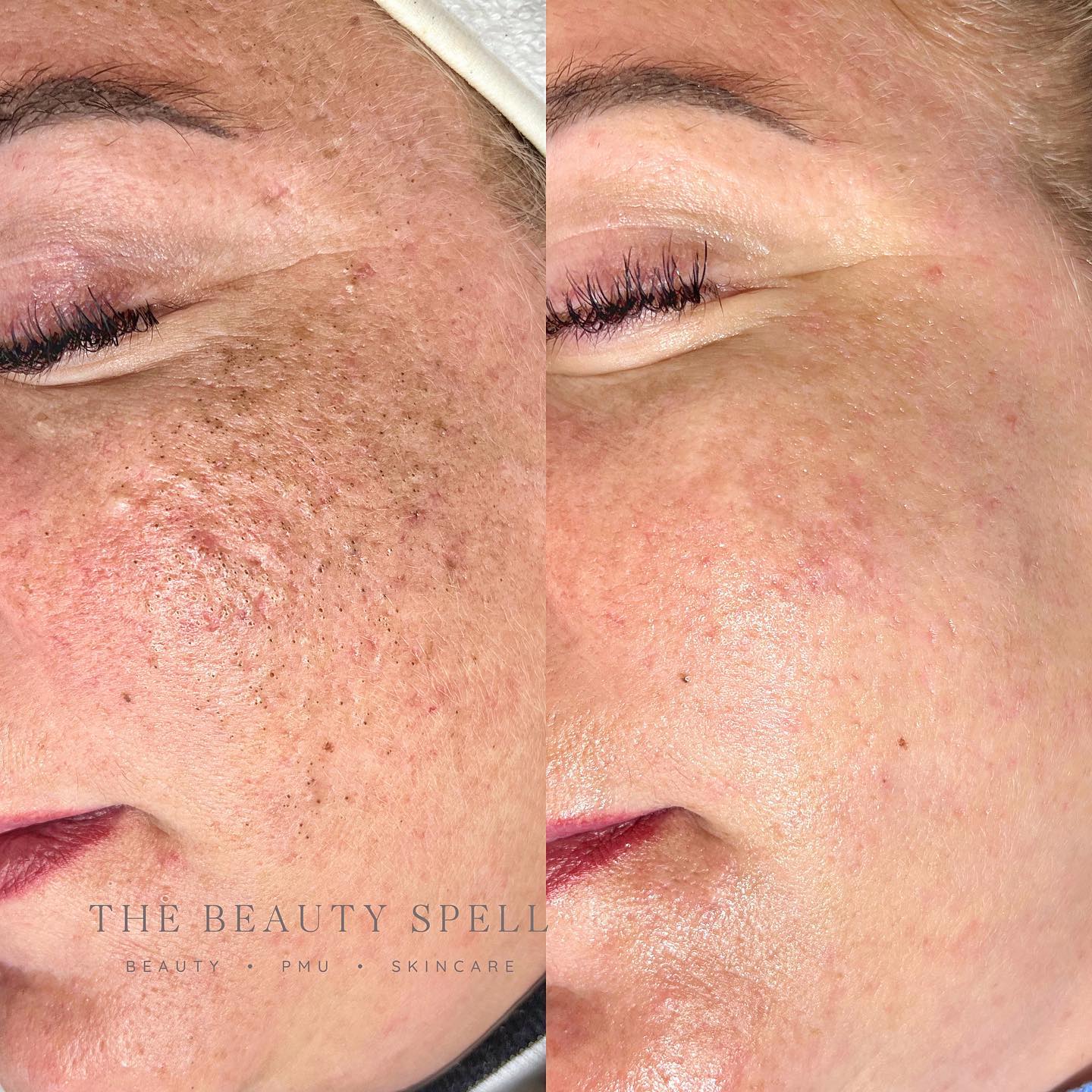 Hydrofacial✨
God i love my job!😭 Can we take a min and just enjoy how clean and blackheadfree her skinn is😍
I don't know about you guys, But i love to see them come out! Oh yeah.. and of course the results after.🙊
#hydrofacial #facialtreatment #facial #skincare #skinhealth #skin #gezichtsbehandeling #gezichtsverzorging