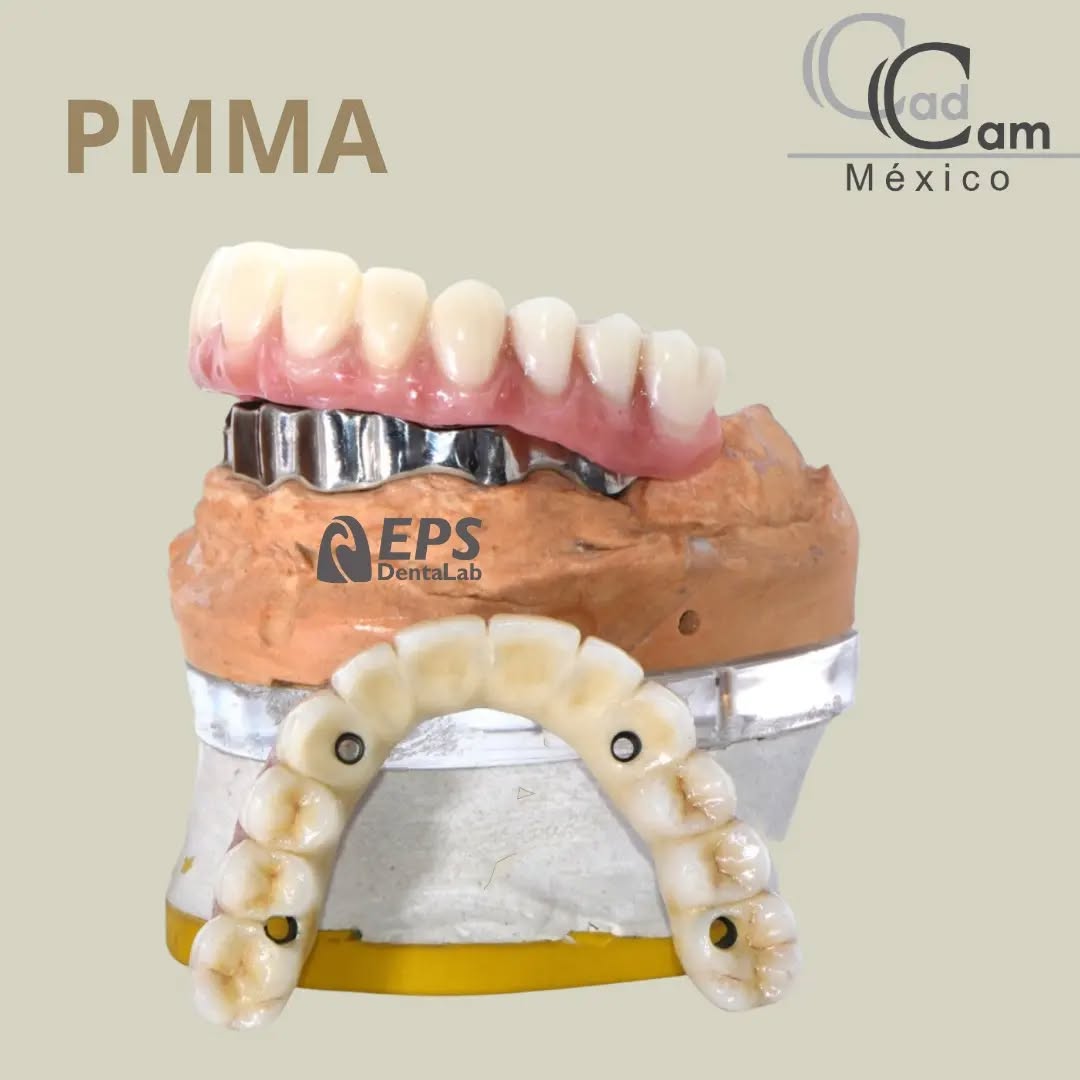 Prótesis completas en PMMA Trabajo de Laboratorio @epslab El PMMA se empleó para realizar un trabajo de restauración completa sobre 4 implantes, una Prótesis de arco completo sobre una estructura de Titanio. ¡Cotiza tu caso con nosotros!
- - - Aviso de responsabilidad: Todas las fotos publicadas en esta cuenta de Instagram son propiedad intelectual de Estudio de Porcelana Suizo S.A de C.V. y están protegidas por derechos de autor.pin alvaro obregon 134 cuernavaca #CadCam #Mexico #Cromocobalto #implantologia #implantesdentales #dentistry #dentista