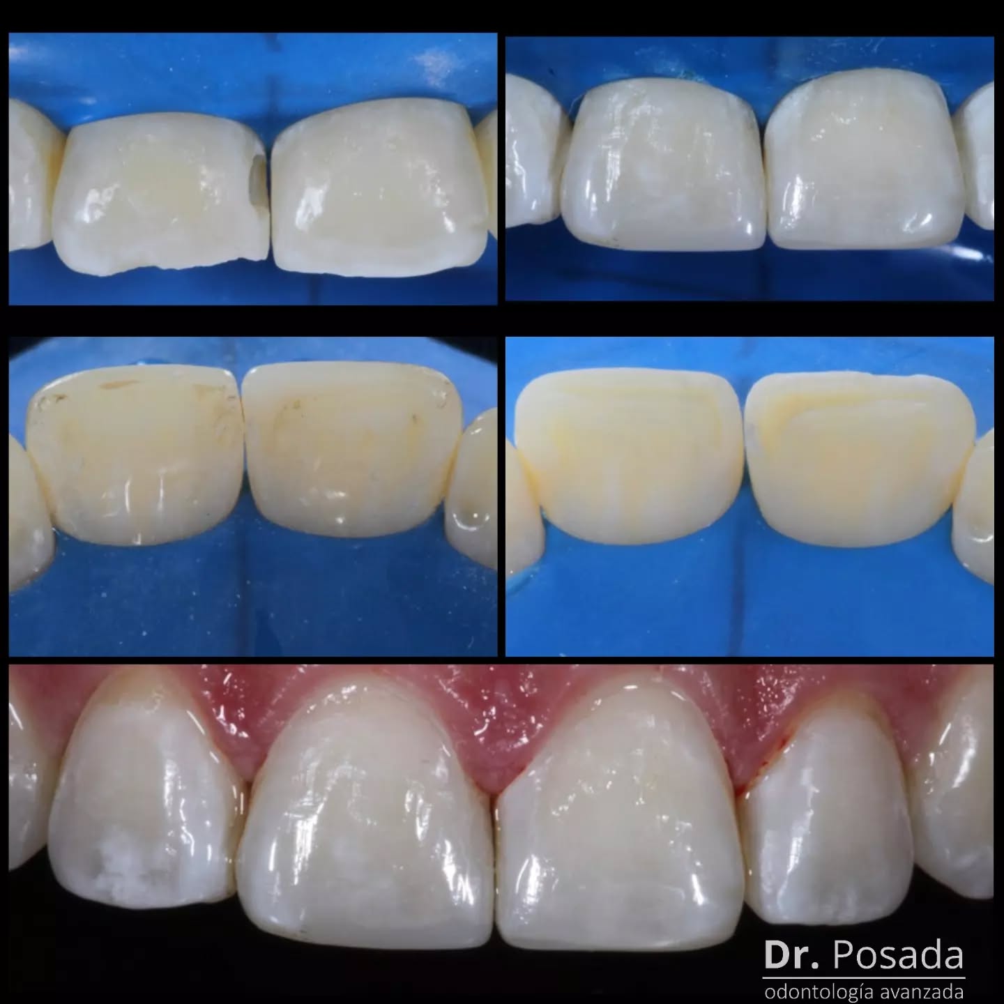 💫💫💫Estos son los cambios naturales🦷🤯 que logramos en una sola sesión, tener una sonrisa😁 sana si es posible y con nuestros especialistas en la clínica👨⚕️ @dr.posada lo puedes lograr
Contáctanos.
☎️ 601 7552046
📲 3046529022
.
.
.
.
.
.
.
.
.
.
.
.
.
.
.
.
#odontologia #beforeandafter #newsmile #resinaestetica #facetaderesina #fotografia #pacientefeliz #top #estetica #alegria #autoestima #smile #teeth #resinadirecta