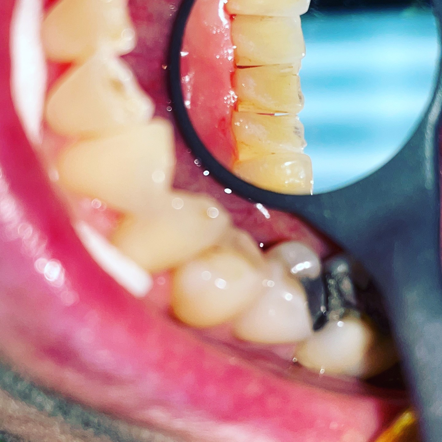 Dentální hygiena je léčebně preventivní metoda, která vede k zachování vlastních zubů v ústech po celý život. Nejnovější medicínské poznatky dokazují, že špatný stav ústní dutiny souvisí s vážnými zdravotními problémy, jako jsou mozkové příhody, záněty kloubů, srdeční a cévní problémy, poruchy trávicího traktu, cukrovka apod. Na fotografii jsou vidět zuby po první dentální hygieně.
#dentalhygiene #dentalcare #prague #hidden #teethcleaning #dentalnihygiena #praha
